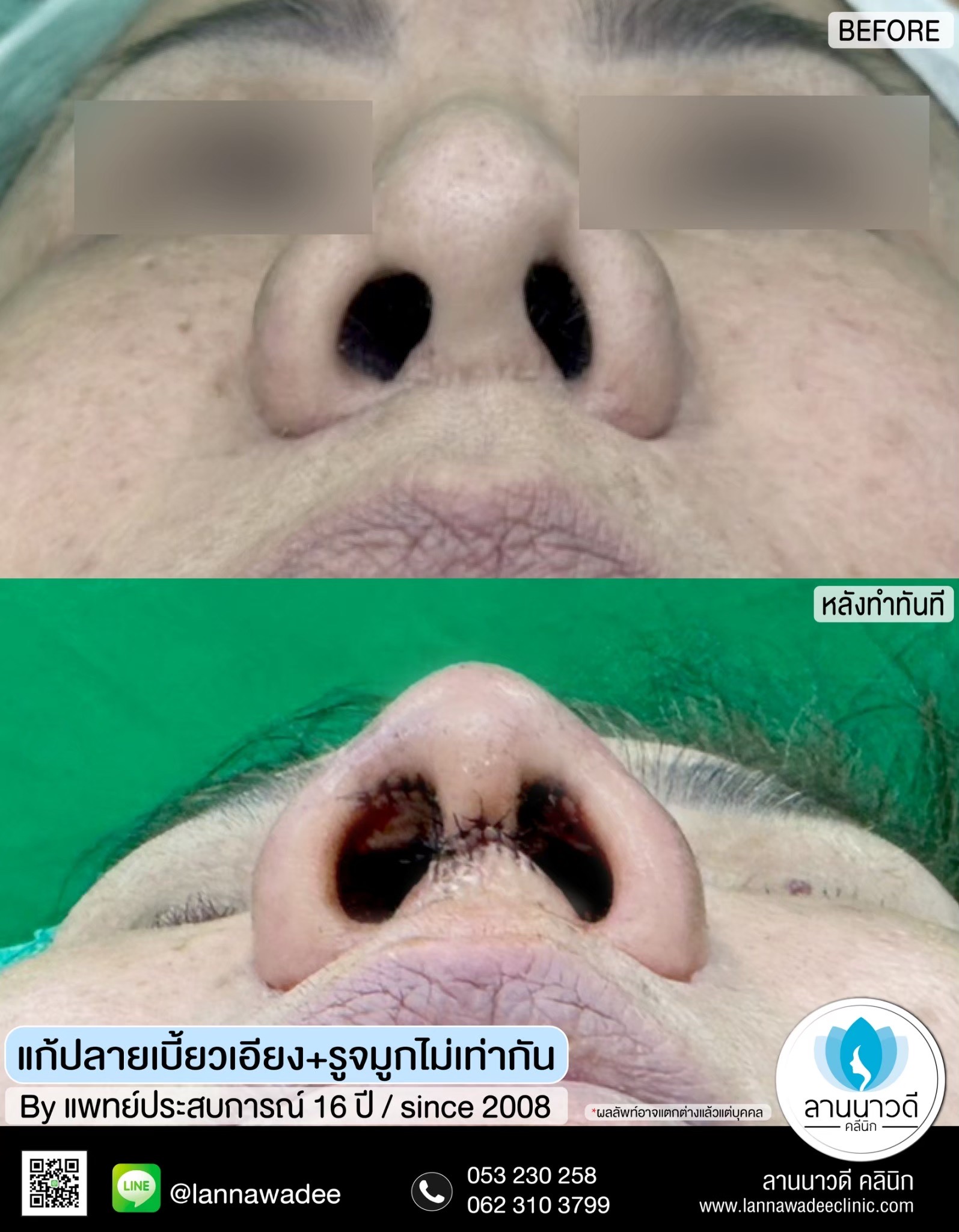 แก้จมูกที่ไหนดี