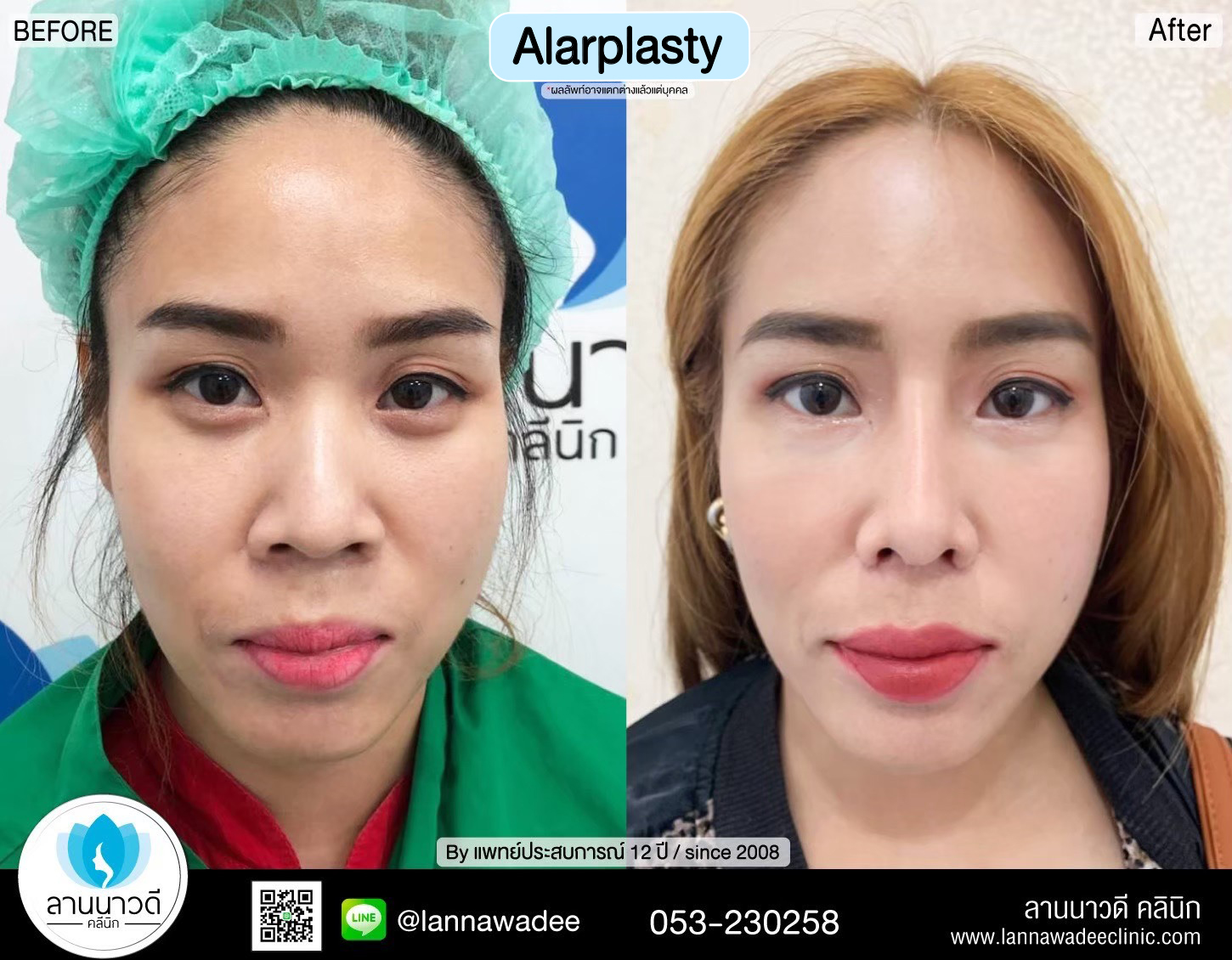 Alarplasty