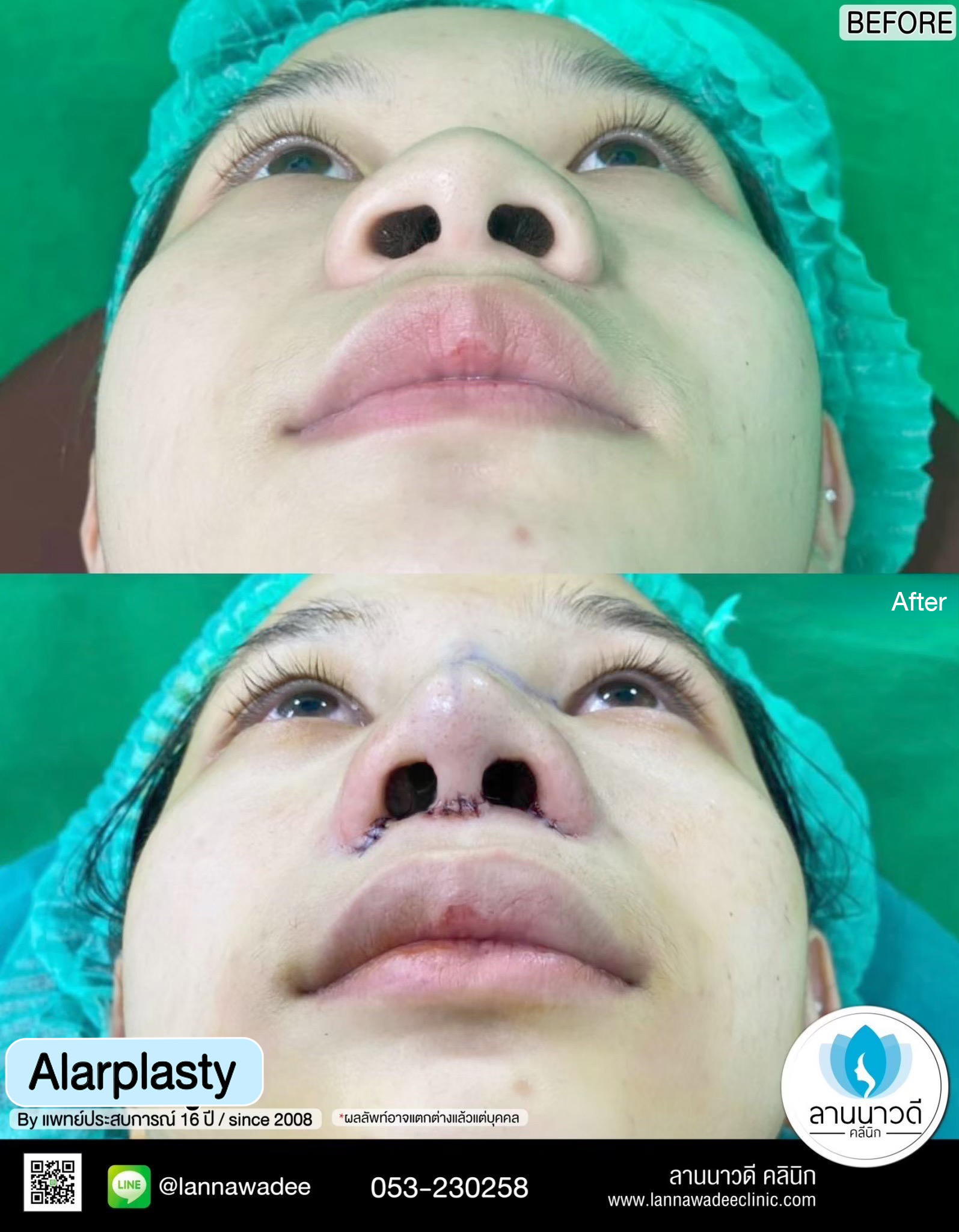 Alarplasty