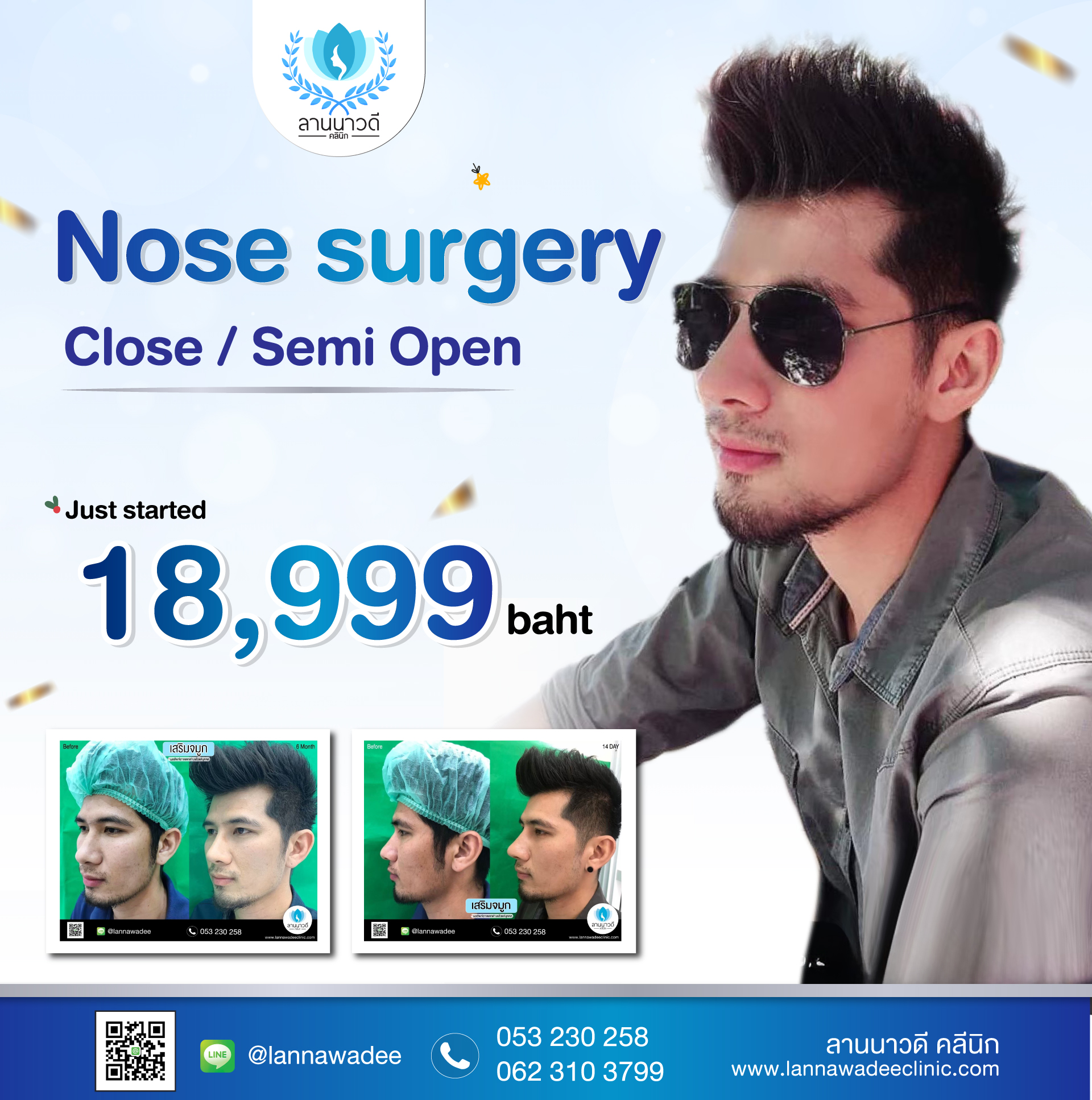 Male Rhinoplasty