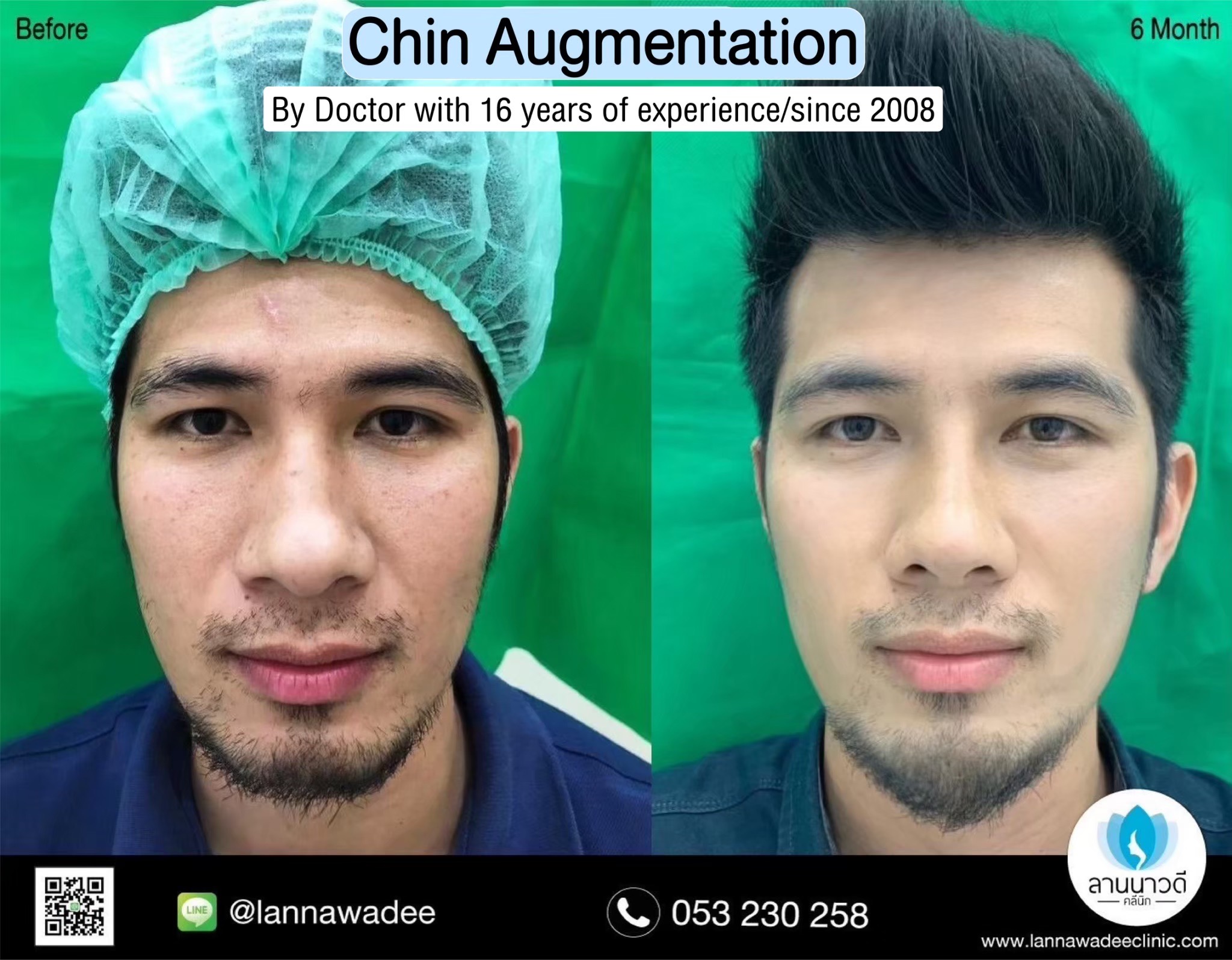 Revision Chin surgery