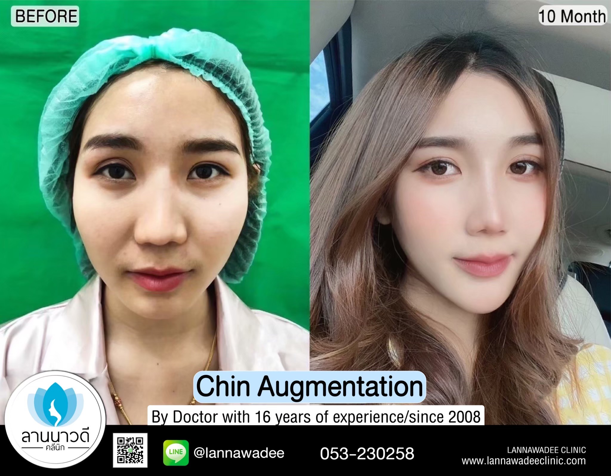 Revision Chin surgery