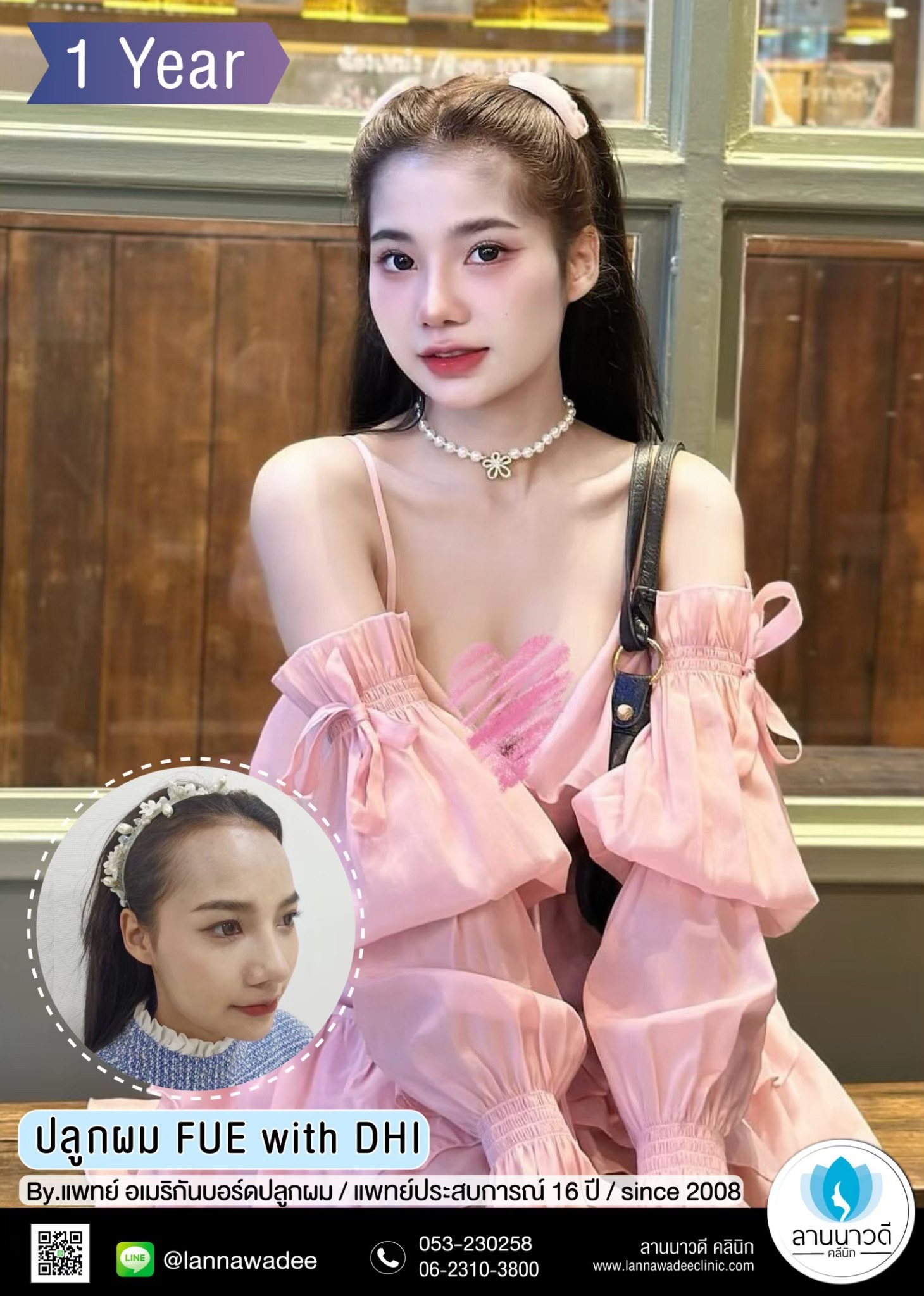 ปลูกผม