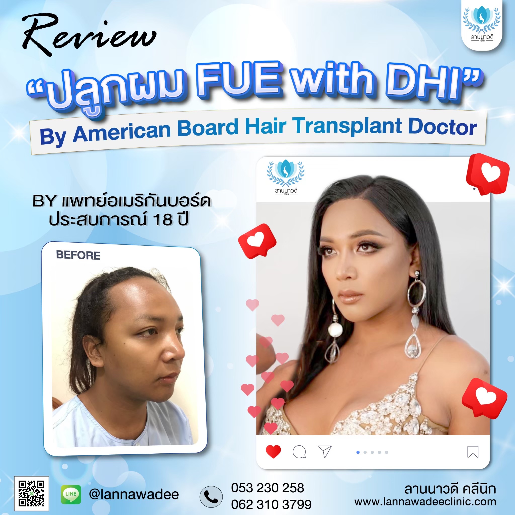ปลูกผม