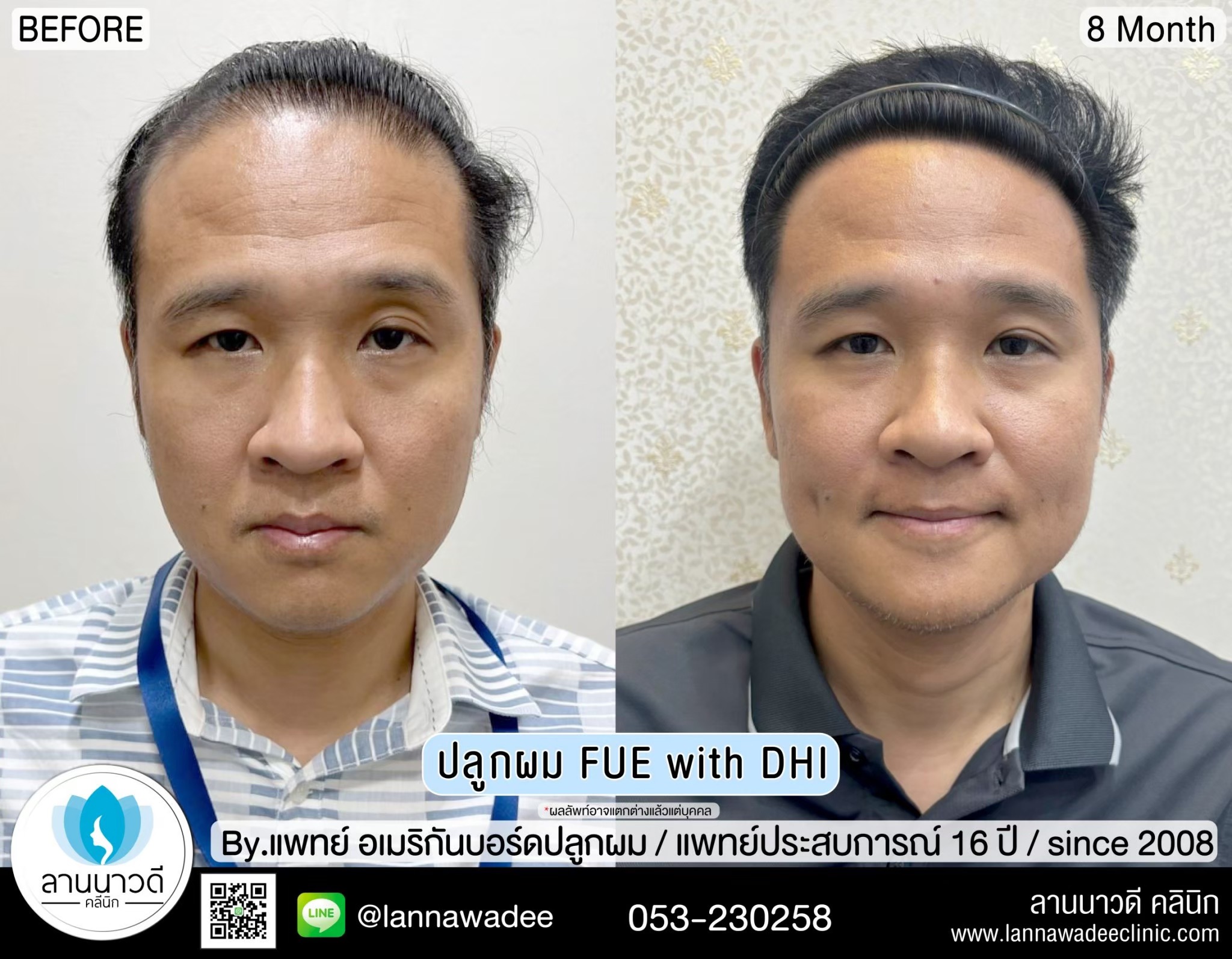 ปลูกผม