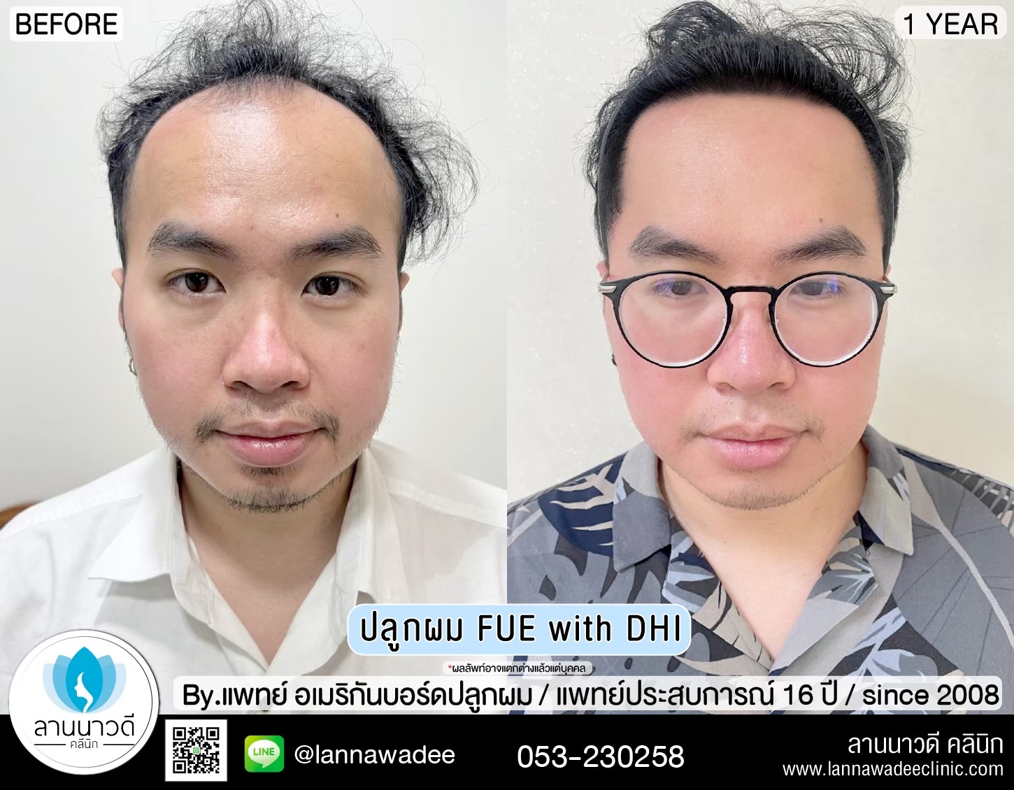 ปลูกผม