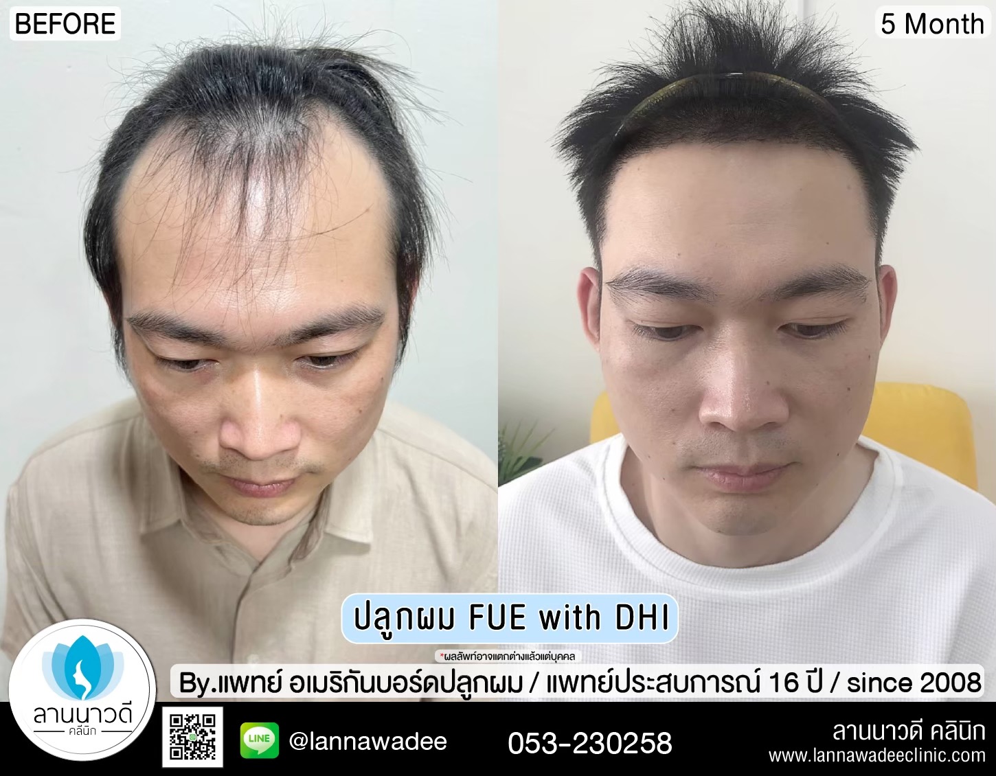 ปลูกผม