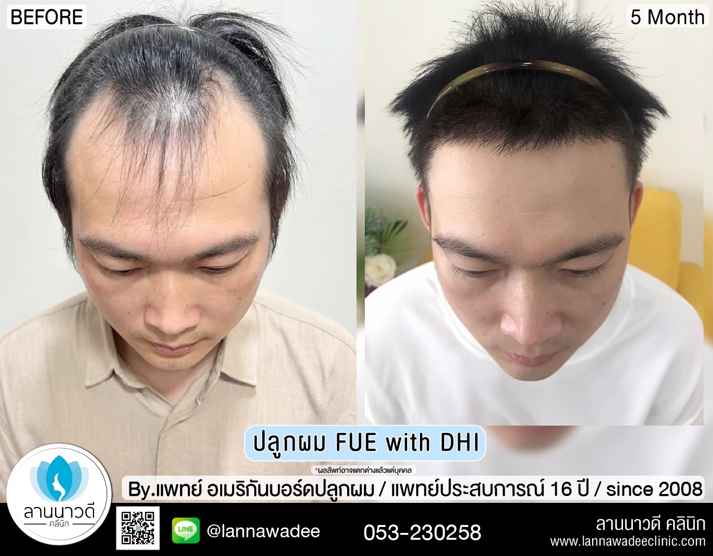 ปลูกผม
