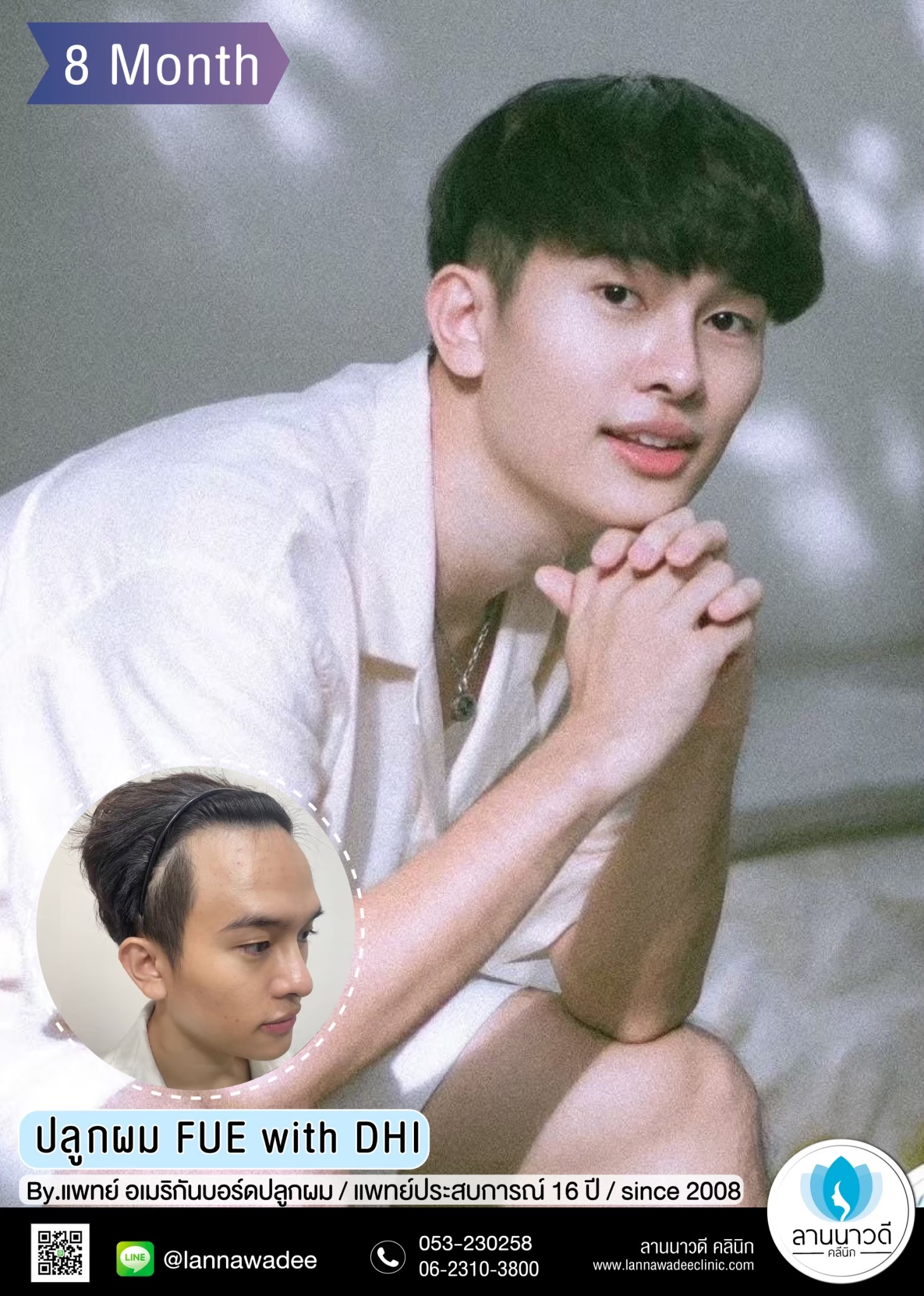 ปลูกผม
