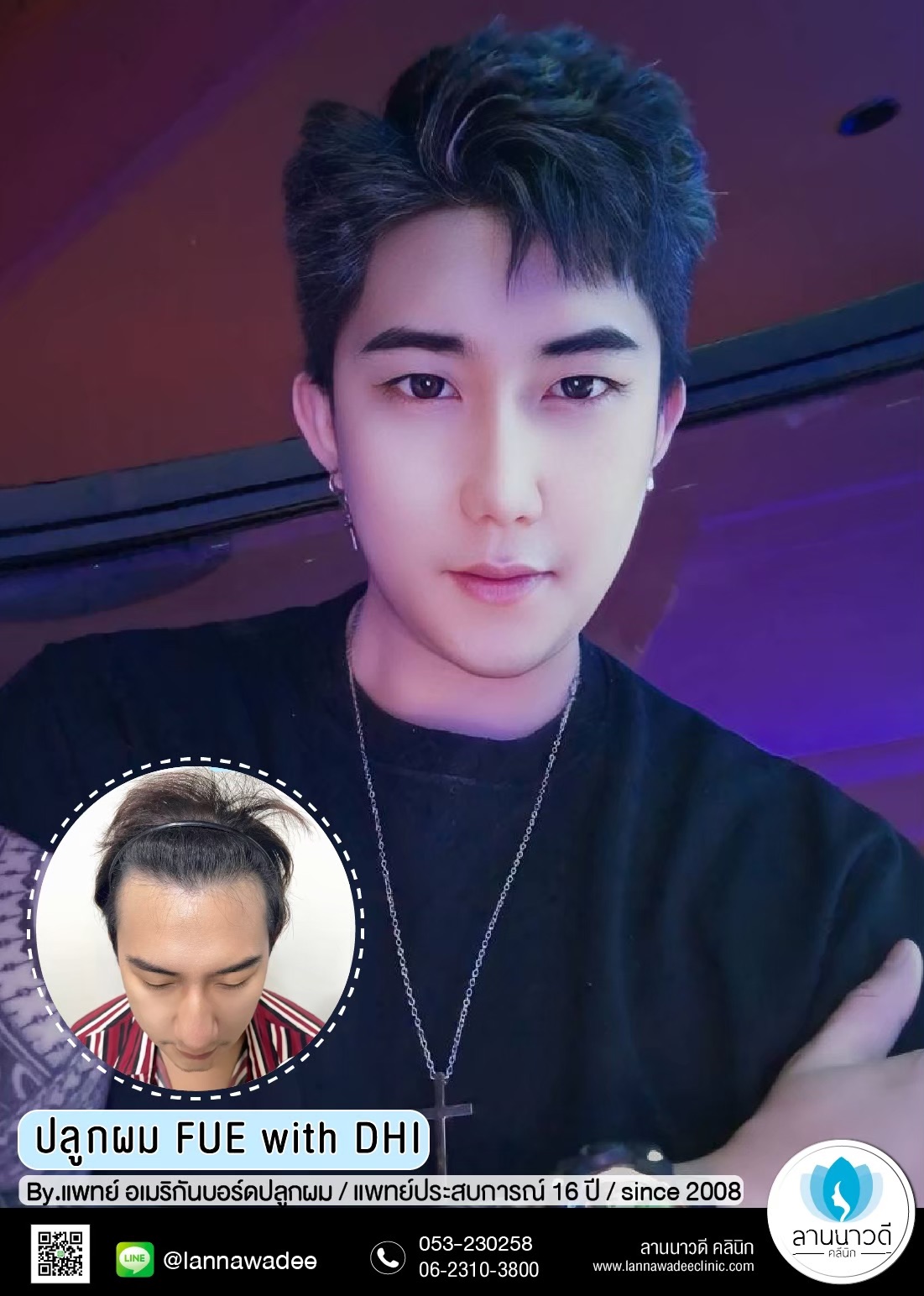 ปลูกผม