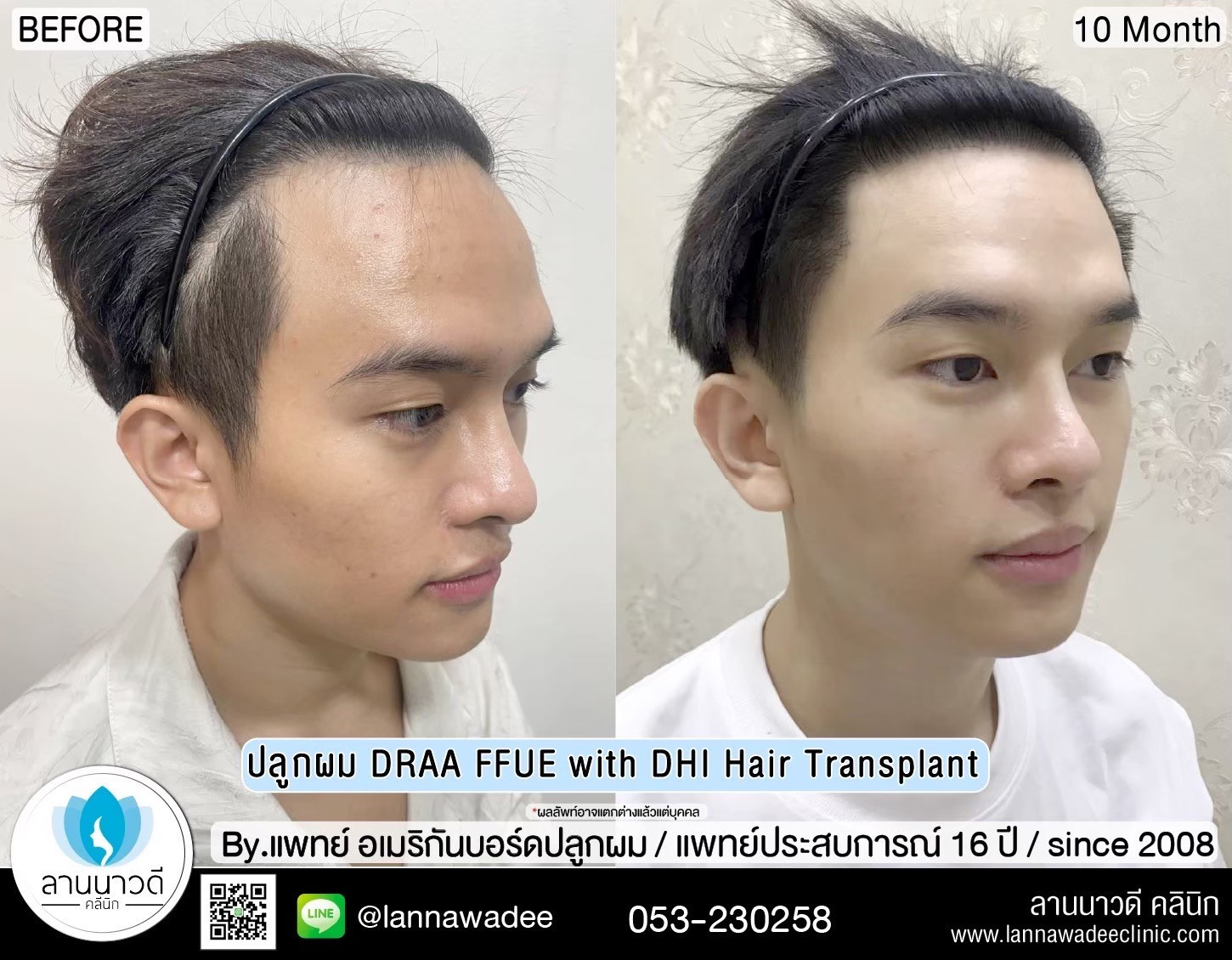 ปลูกผม