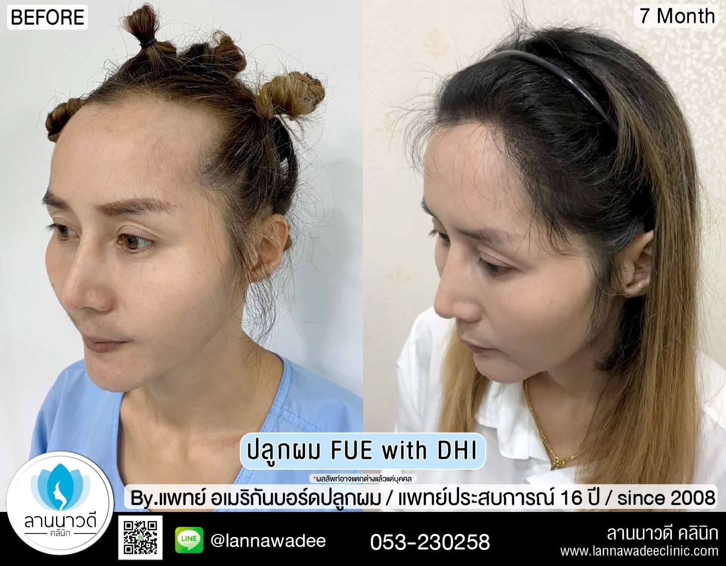 ปลูกผม