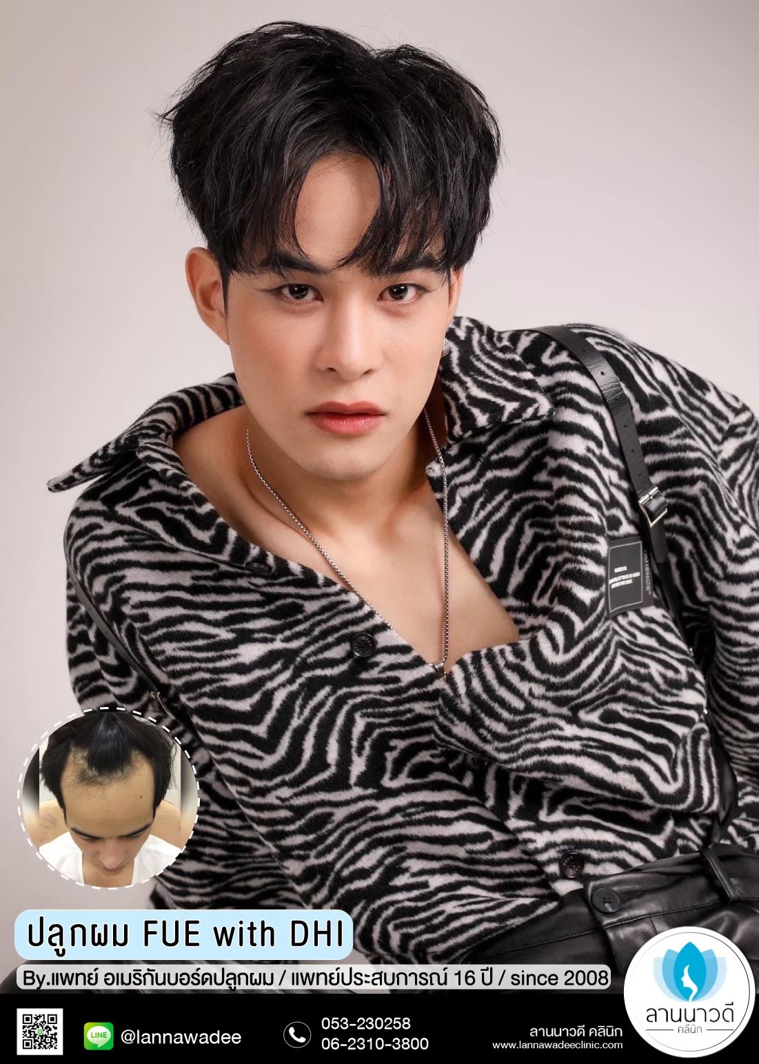 ปลูกผม