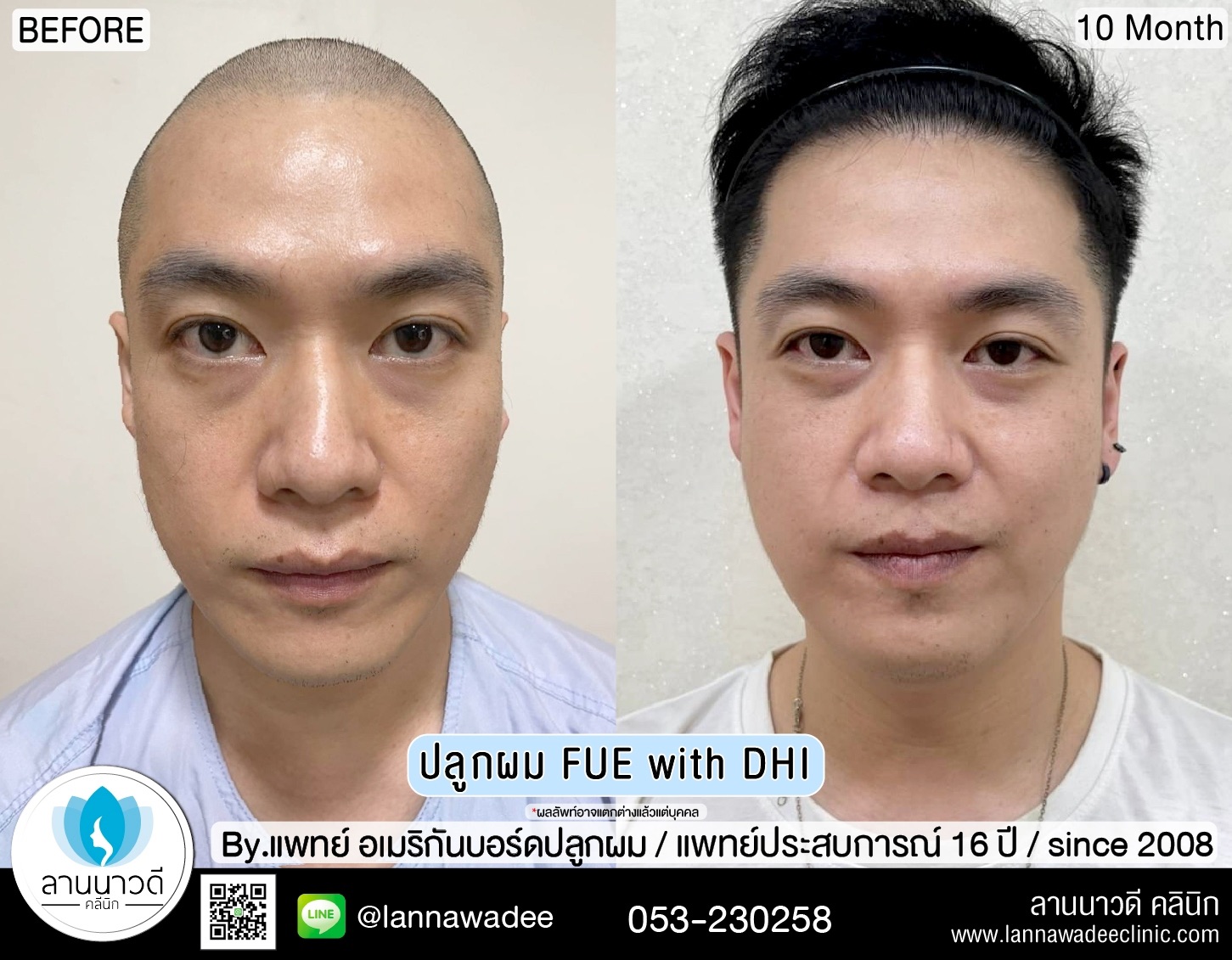 ปลูกผม