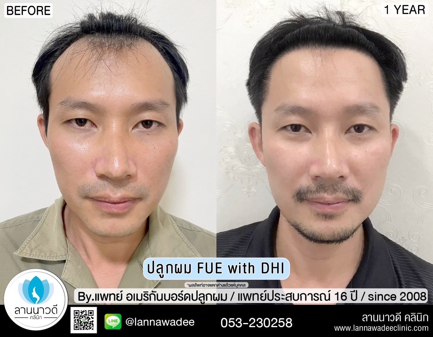 ปลูกผม