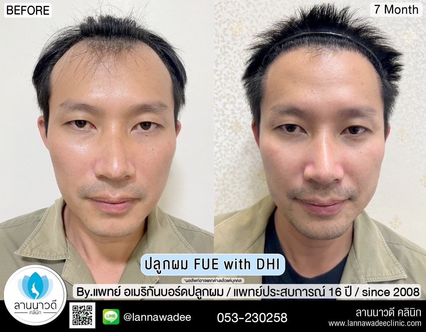 ปลูกผม