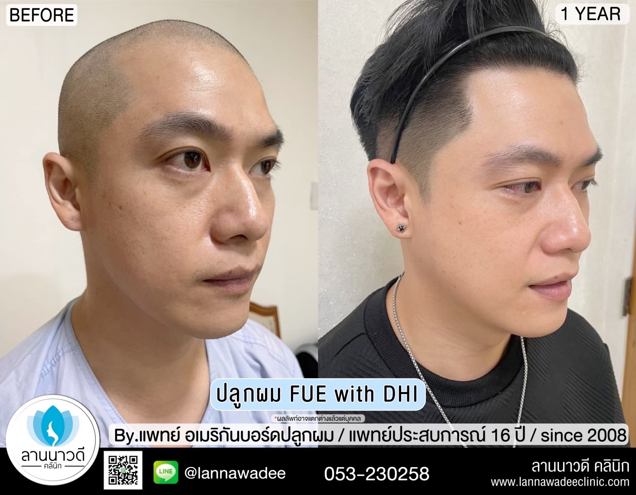 ปลูกผม