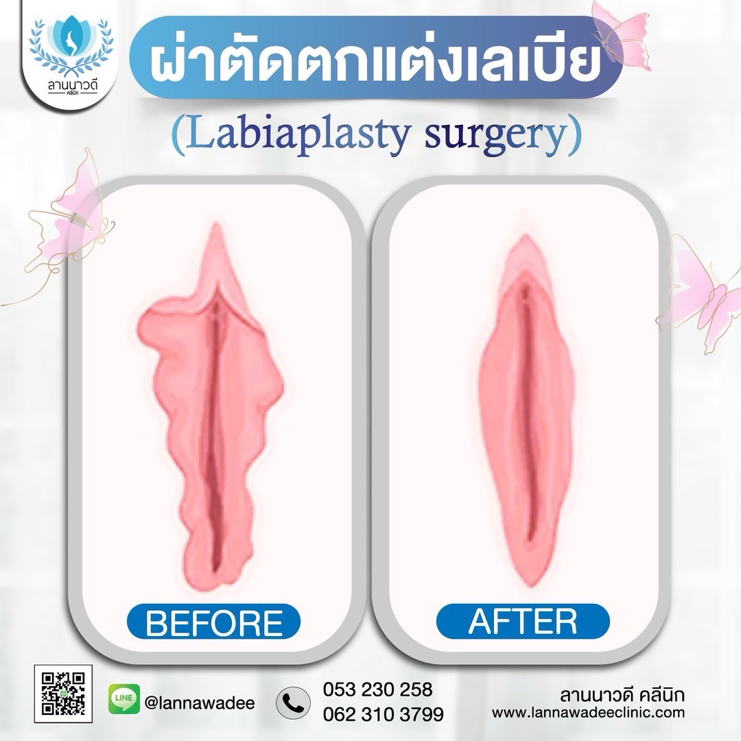 ผ่าตัดเลเบียเชียงใหม่
