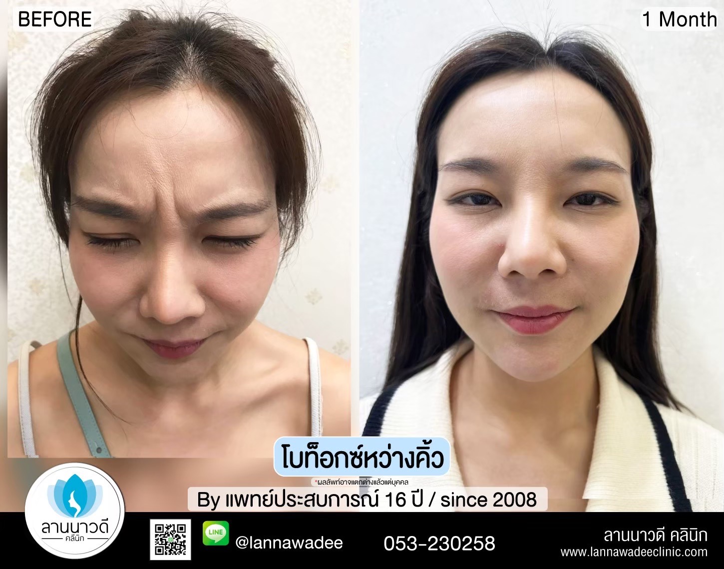 ฉัดโบท๊อก