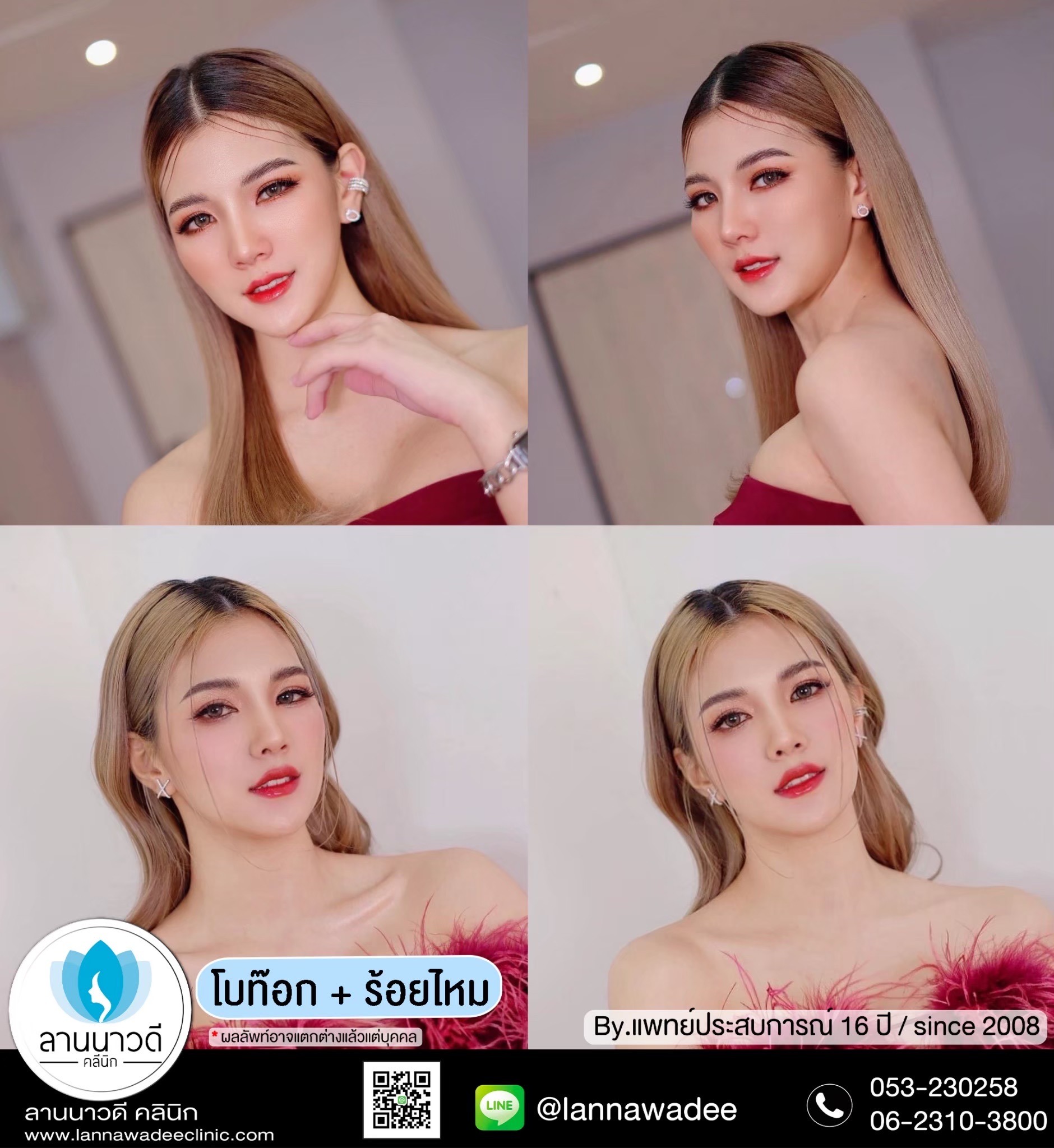 ฉีดโบท็อก