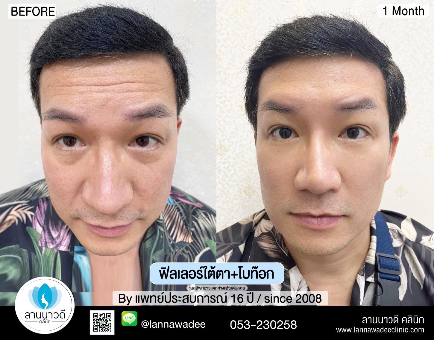 ลดริ้วรอยเชียงใหม่