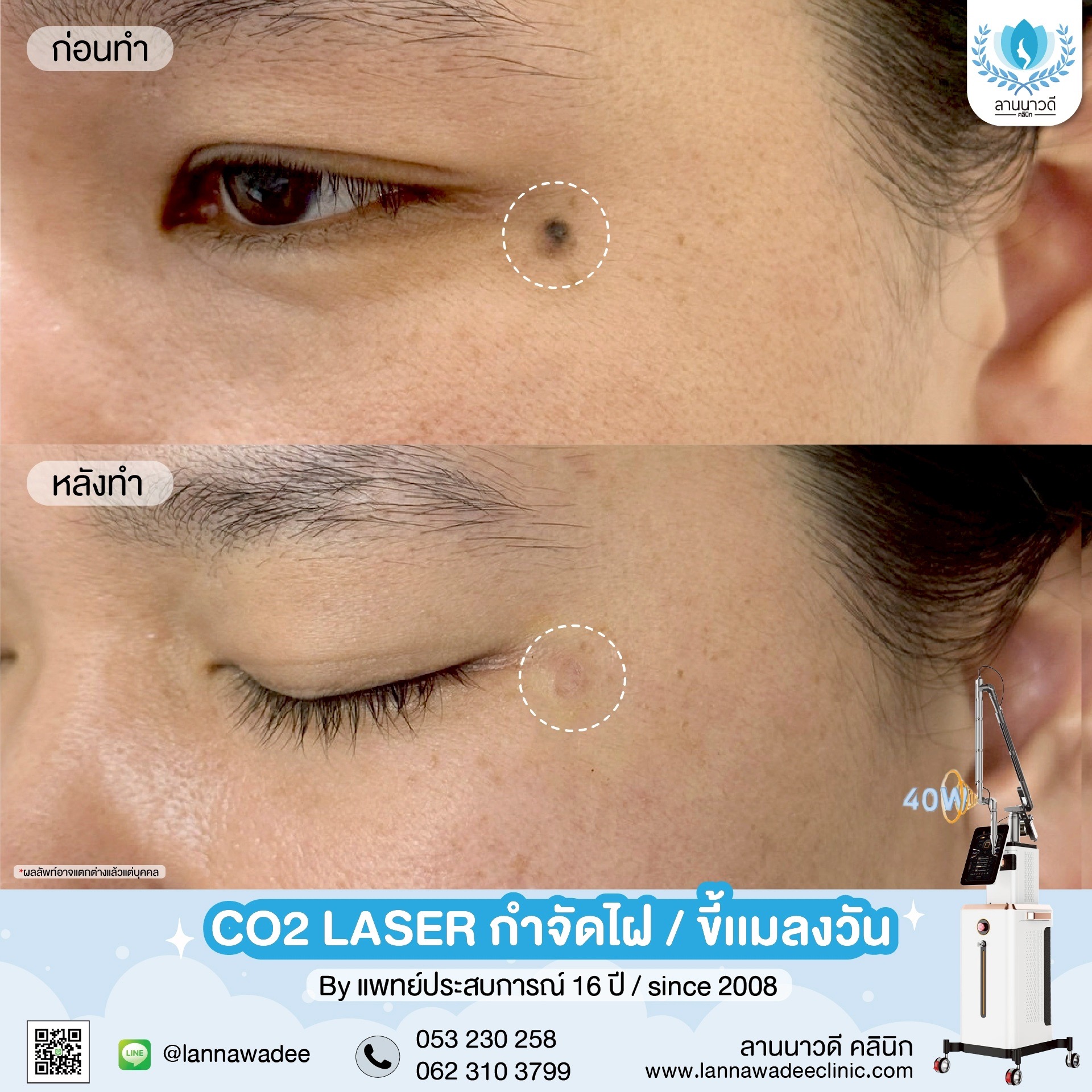 กำจัดไฝเชียงใหม่