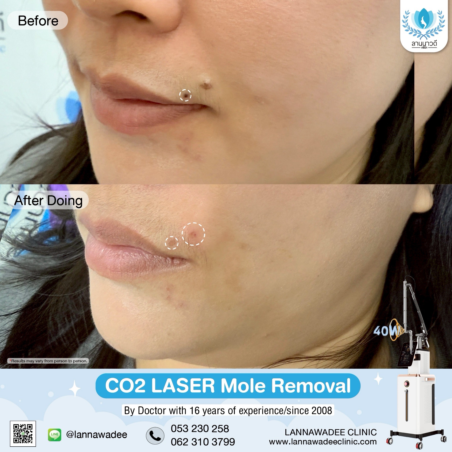 Mole removal