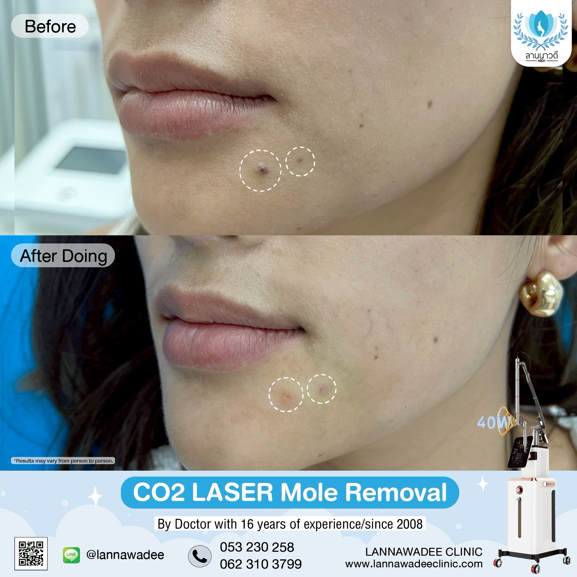 Mole removal
