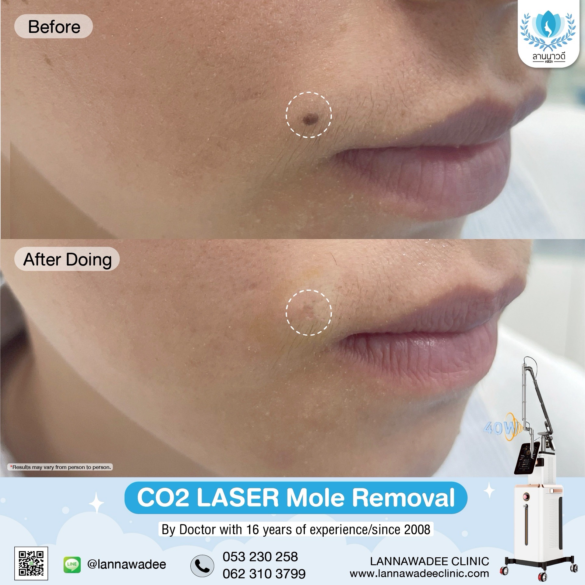 Mole removal