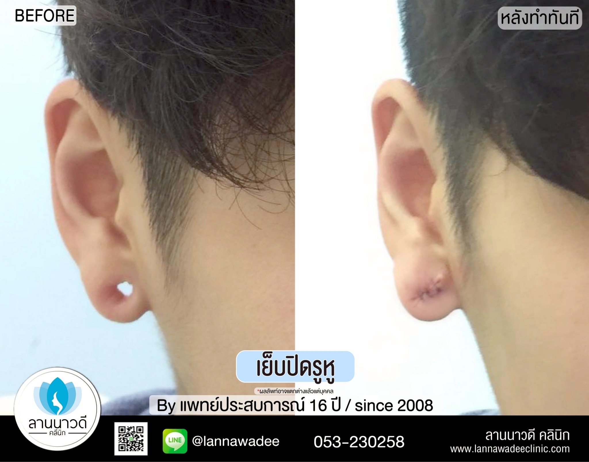 เย็บปิดรูหู