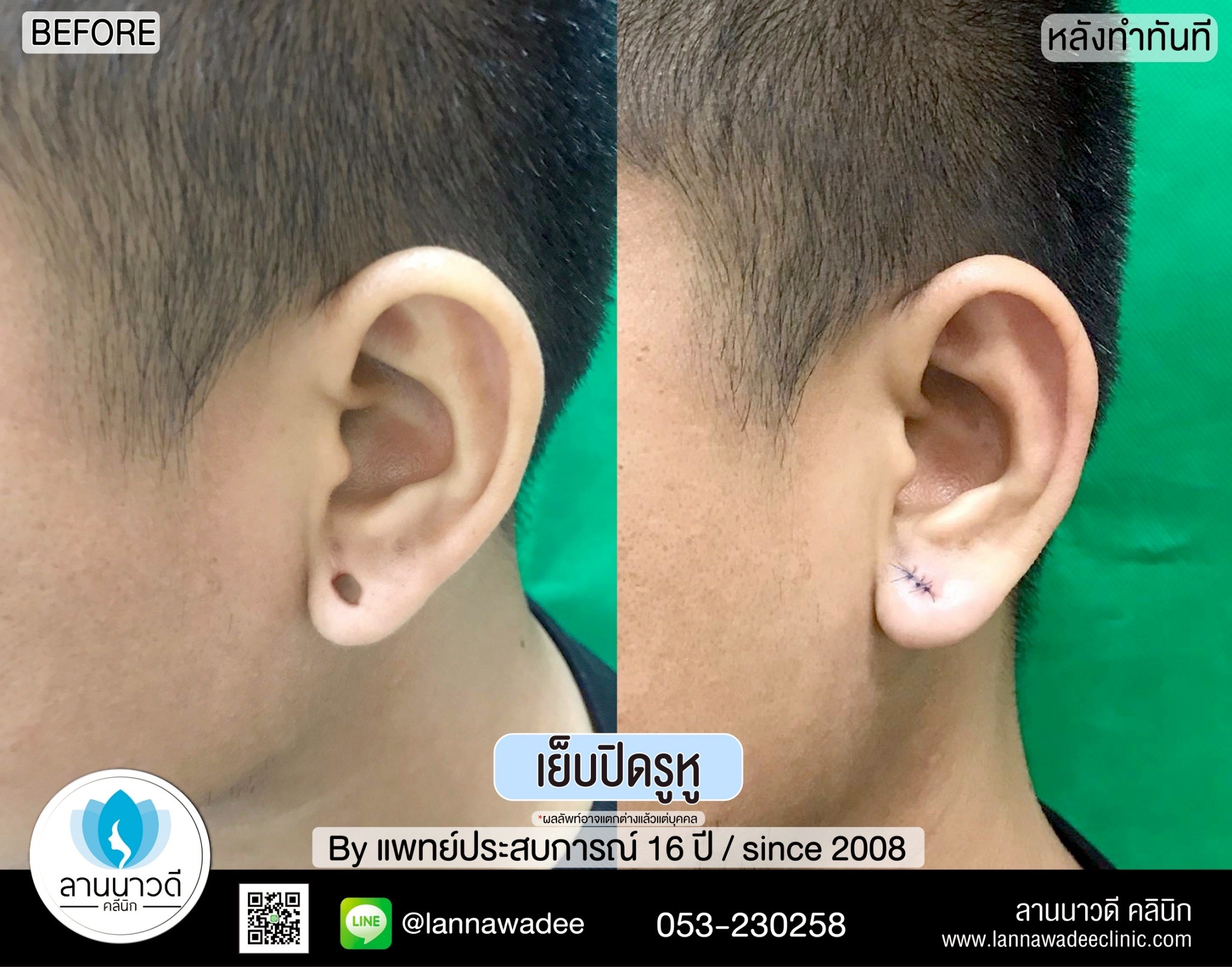 เย็บปิดรูหูเชียงใหม่