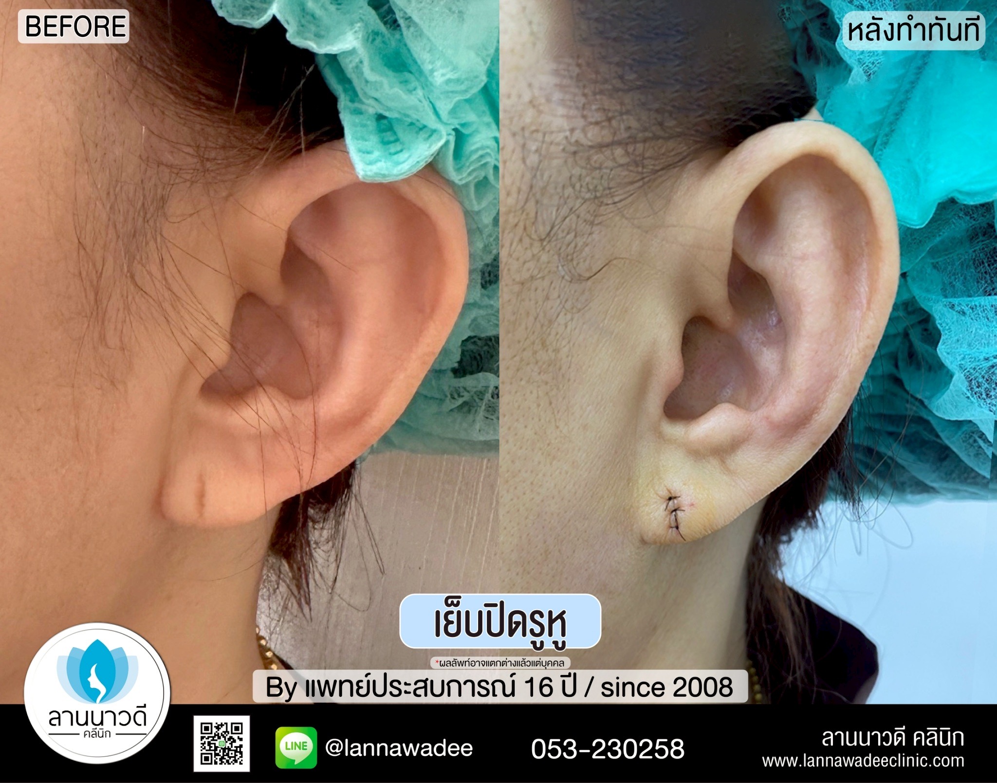 เย็บปิดรูหูเชียงใหม่
