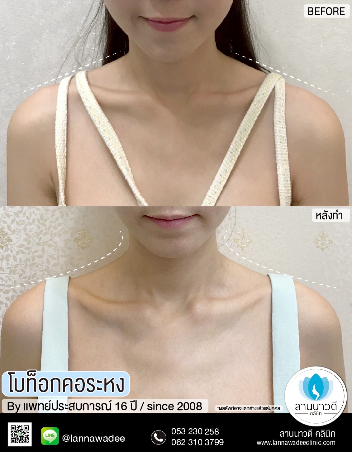 ฉีดคอระหง