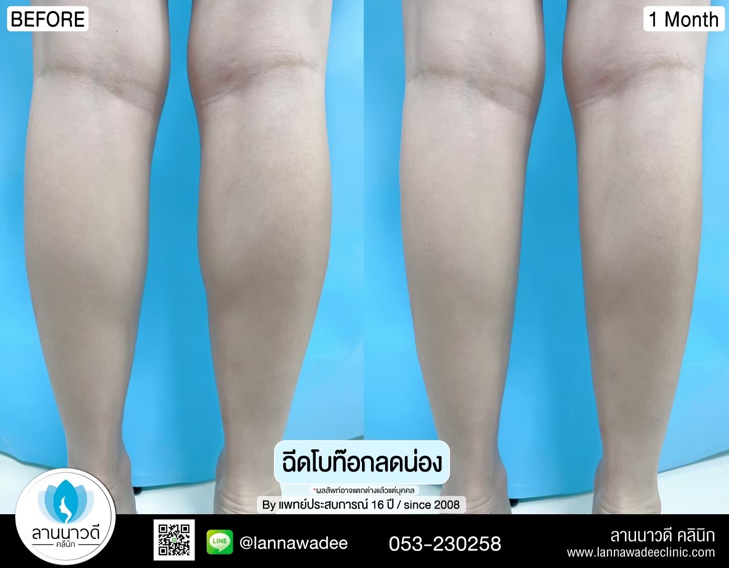โบท็อกซ์ลดน่อง