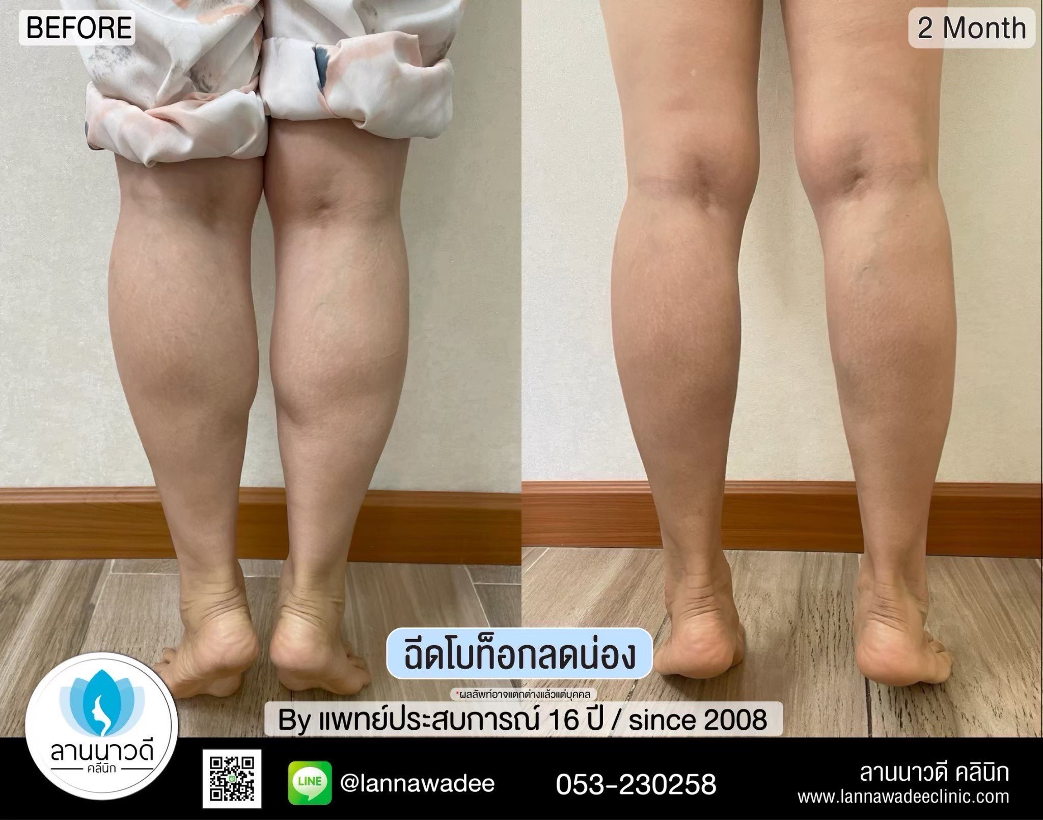 ฉีดโบท็อกน่อง