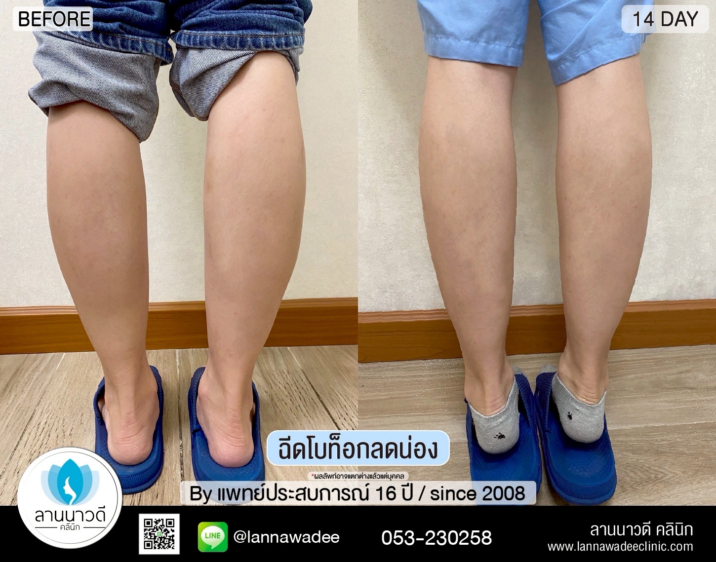 ลดน่อง