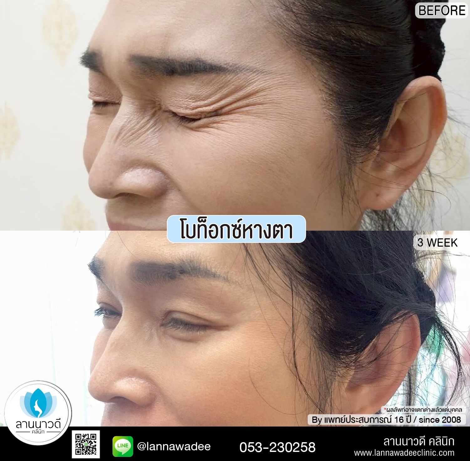ลดน่องเชียงใหม่