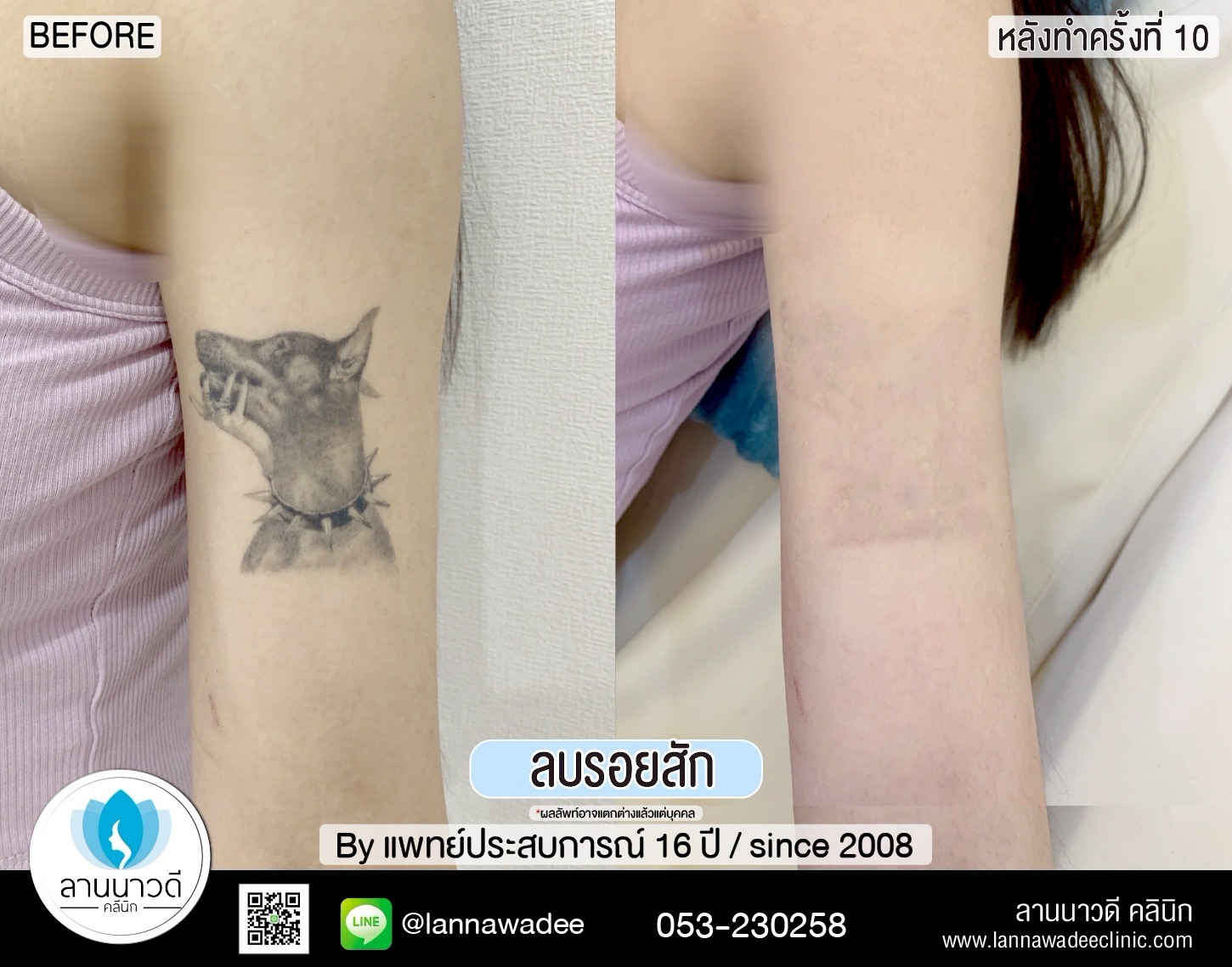 ลบรอยสัก