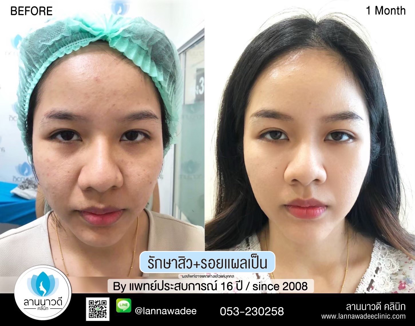 เลเซอร์หลุมสิวที่ไหนดี