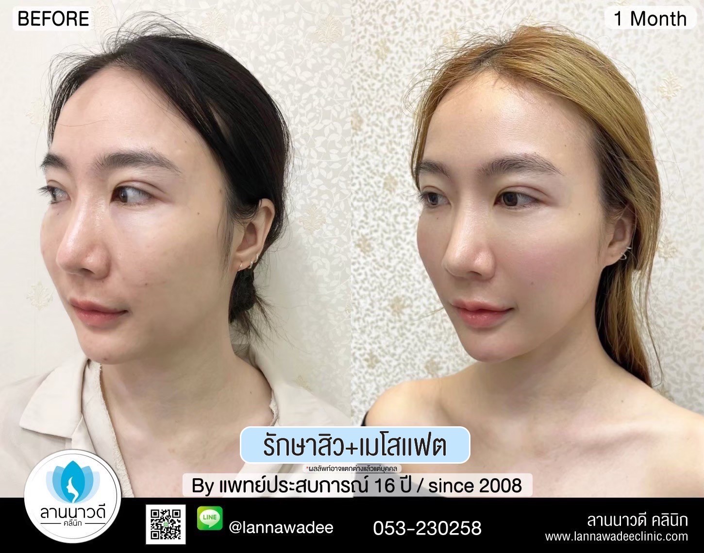เลเซอร์หลุมสิวที่ไหนดี