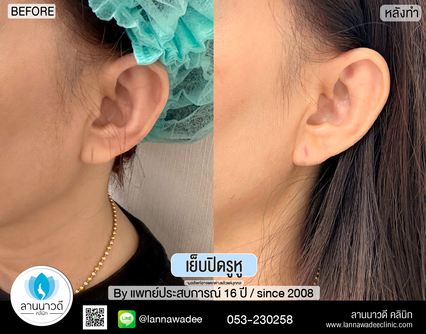 เย็บรูปหูที่ไหนดี