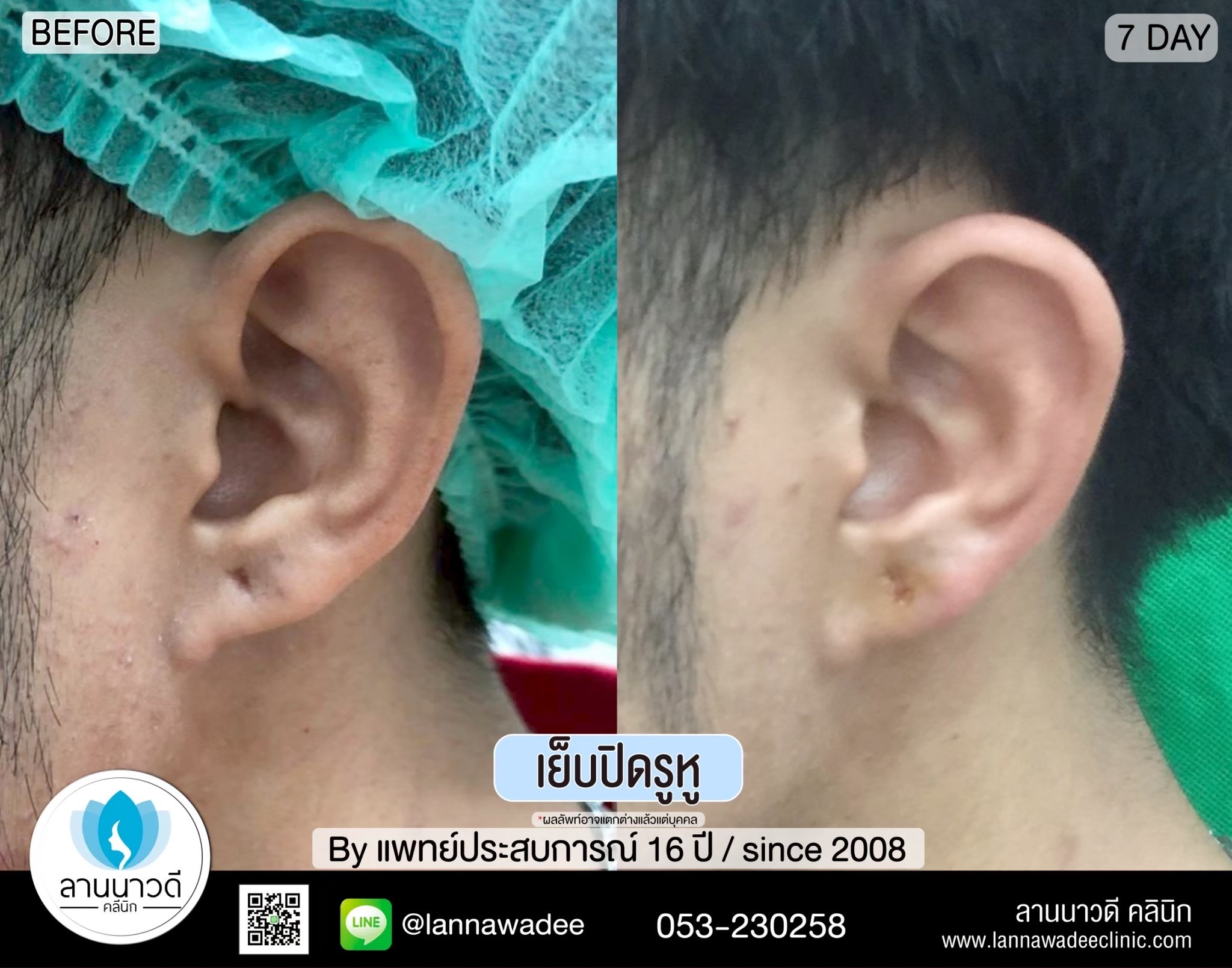 เย็บรูหู