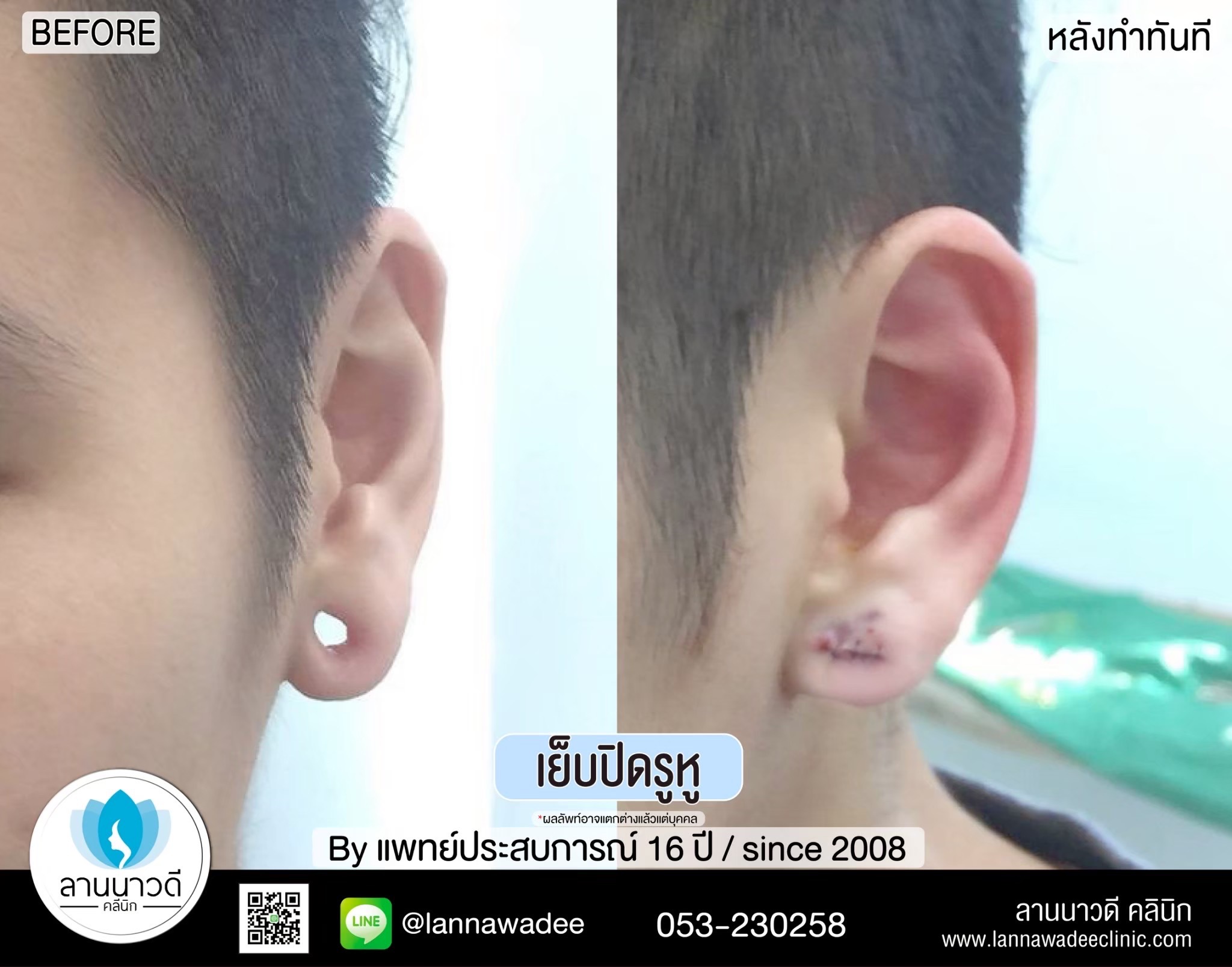 เย็บรูหู