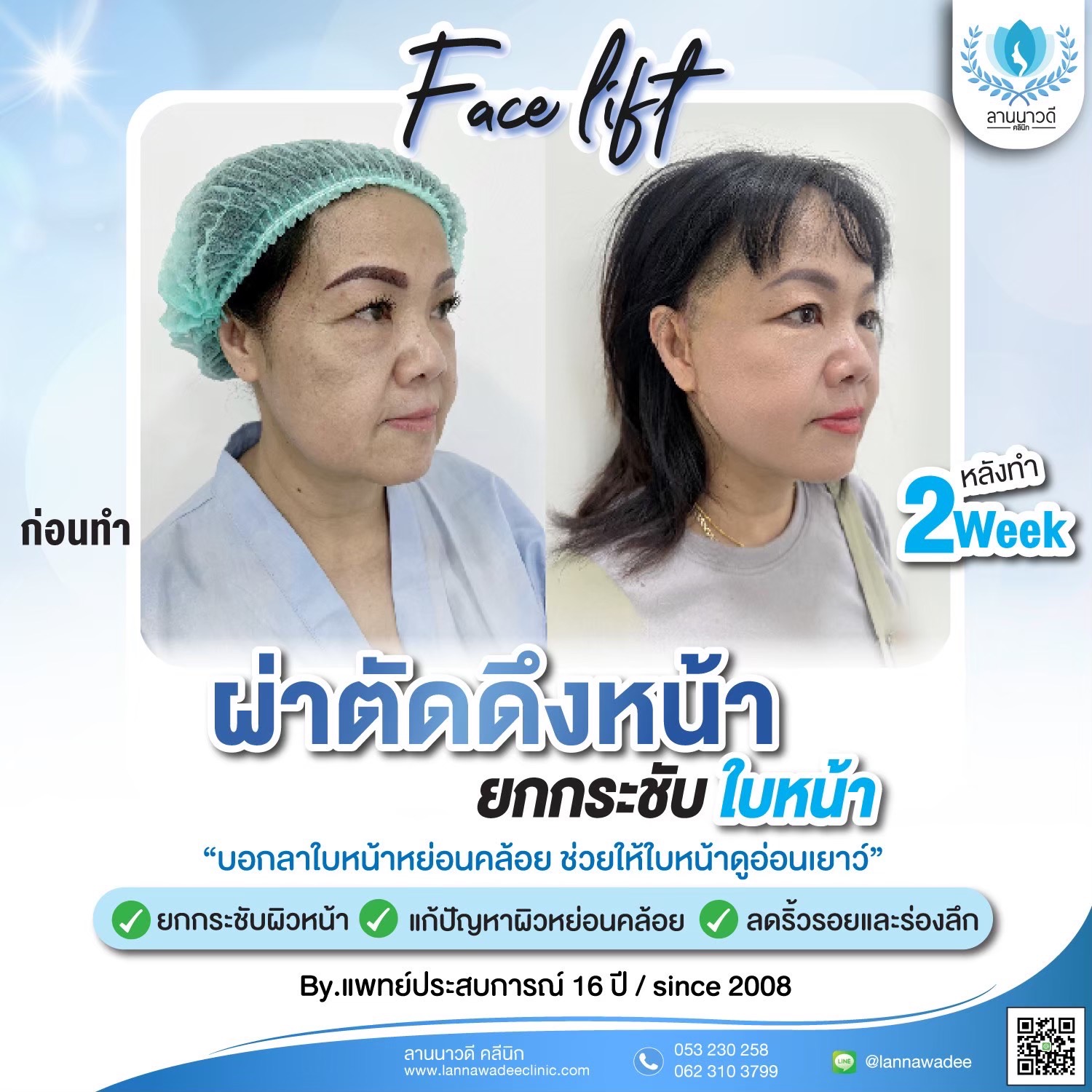 ผ่าตัดดึงหน้า