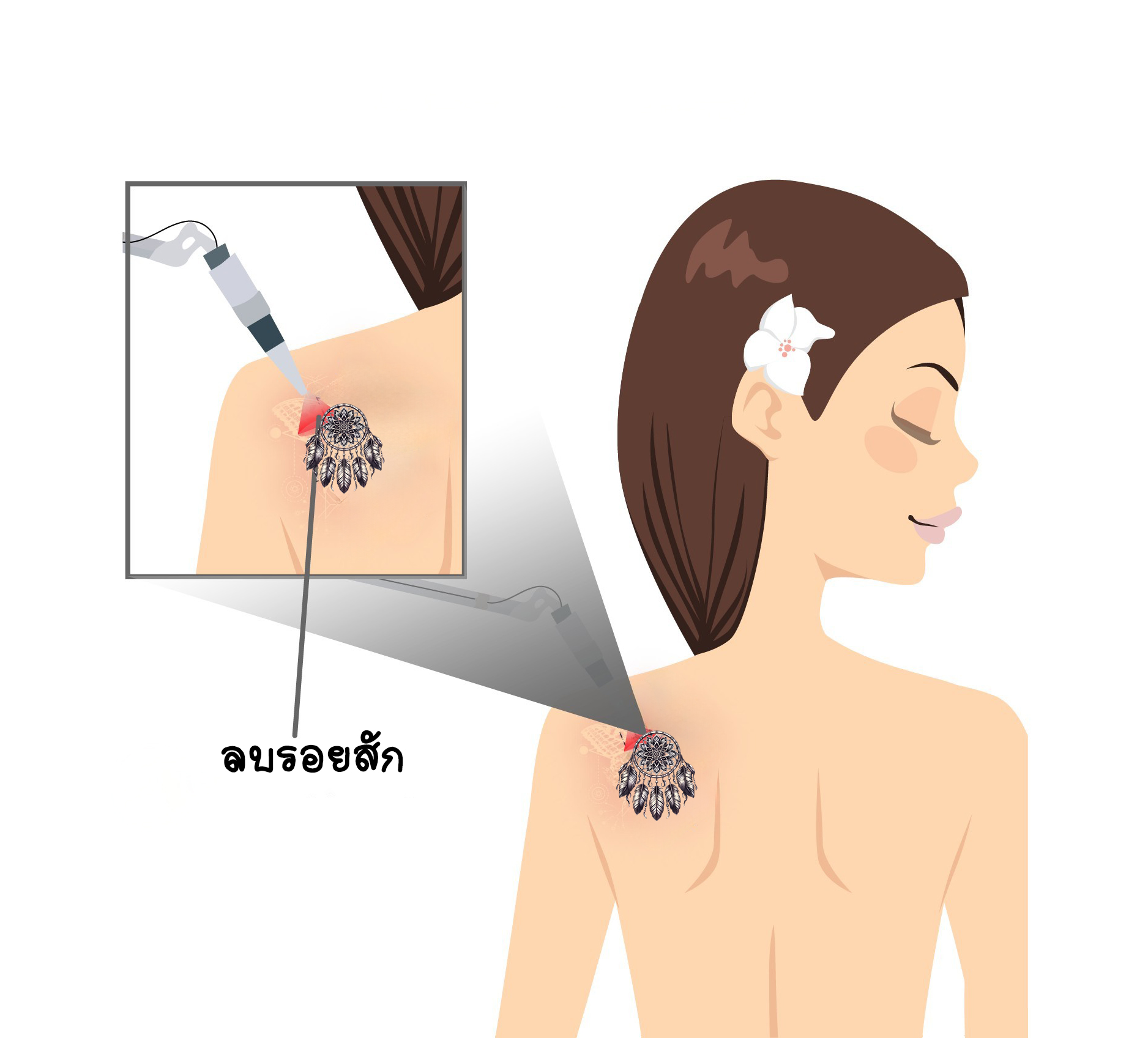 ลบรอยสัก