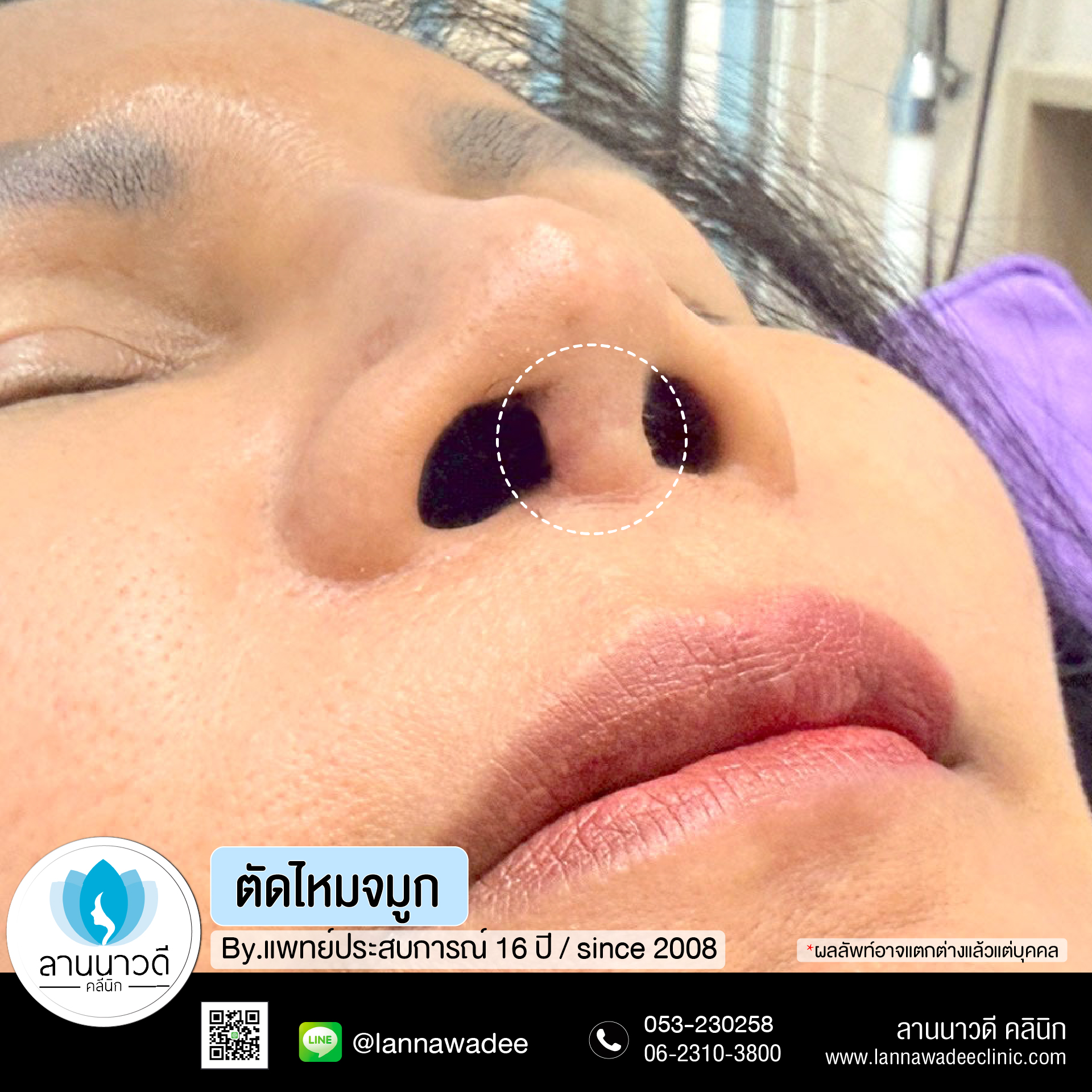 ตัดไหมเชียงใหม่