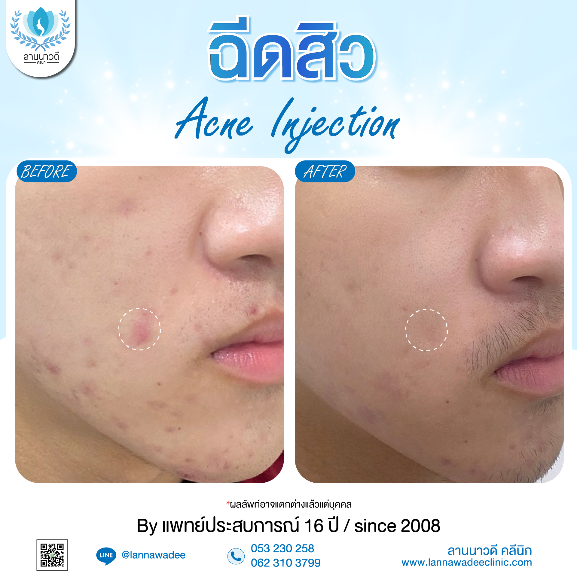ฉีดสิว