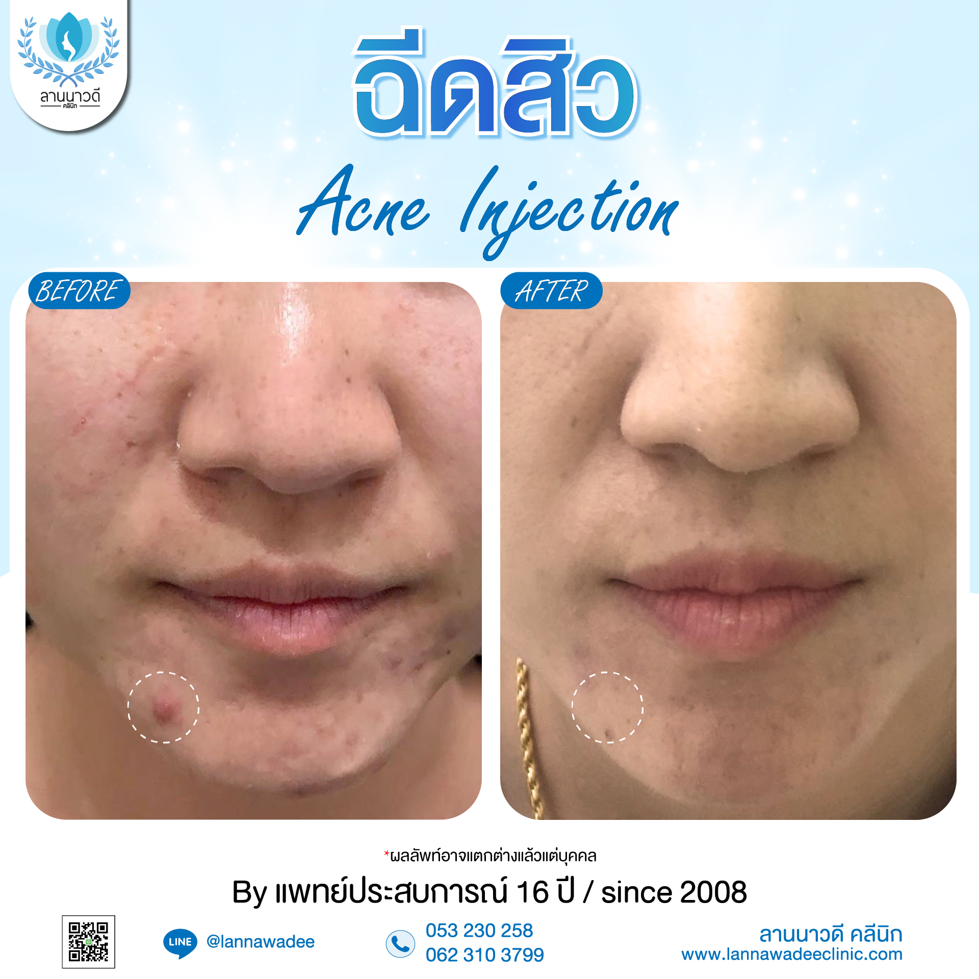ฉีดสิว