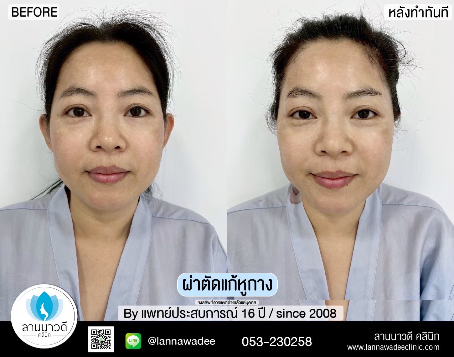 แก้หูกาง