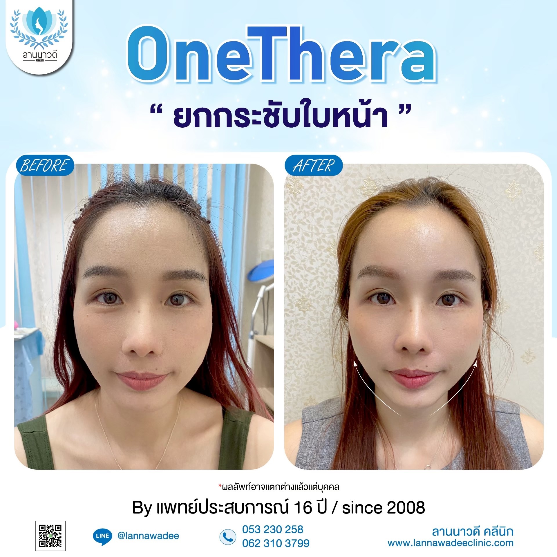ยกกระชับใบหน้า